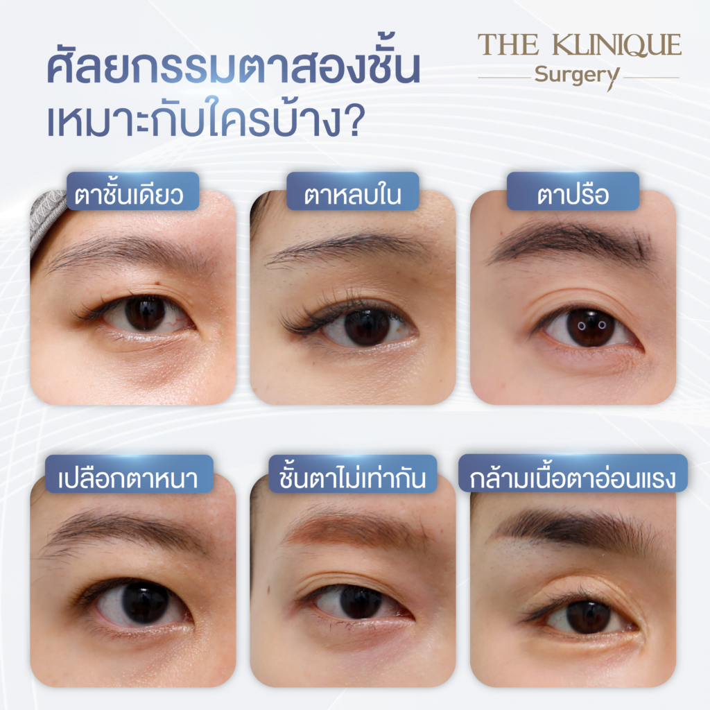 ศัลยกรรมตา, ศัลยกรรมตาสองชั้น, ศัลยกรรมตาสองชั้น ราคา, ศัลยกรรมตาที่ไหนดี, ศัลยกรรมตามีกี่แบบ, ตาสองชั้น, ตาสองชั้นหลบใน, คลินิกทำตา, ตาสองชั้นที่ไหนดี, ตาสองชั้นแบบกรีดสั้น กรีดยาว, กล้ามเนื้อตาอ่อนแรง, แก้ตา, แก้ตาสองชั้น, แก้หนังตาตก, แก้ชั้นตาใหญ่, แก้ตาไม่เท่ากัน, หนังตาตก, แก้หนังตาตก
