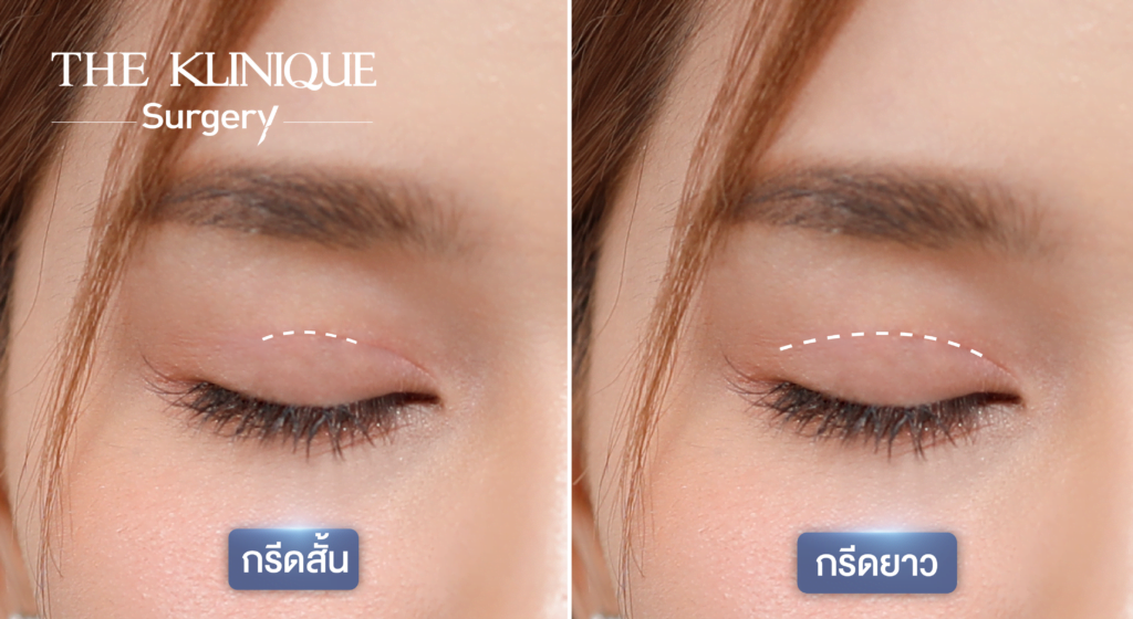 ศัลยกรรมตา, ศัลยกรรมตาสองชั้น, ศัลยกรรมตาสองชั้น ราคา, ศัลยกรรมตาที่ไหนดี, ศัลยกรรมตามีกี่แบบ, ตาสองชั้น, ตาสองชั้นหลบใน, คลินิกทำตา, ตาสองชั้นที่ไหนดี, ตาสองชั้นแบบกรีดสั้น กรีดยาว, กล้ามเนื้อตาอ่อนแรง, แก้ตา, แก้ตาสองชั้น, แก้หนังตาตก, แก้ชั้นตาใหญ่, แก้ตาไม่เท่ากัน, หนังตาตก, แก้หนังตาตก
