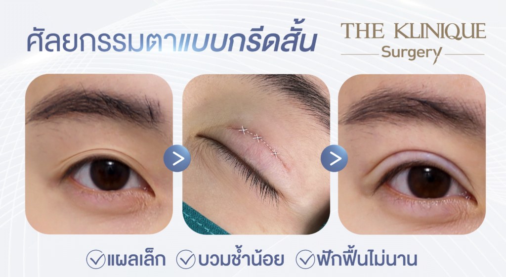 ศัลยกรรมตา, ศัลยกรรมตาสองชั้น, ศัลยกรรมตาสองชั้น ราคา, ศัลยกรรมตาที่ไหนดี, ศัลยกรรมตามีกี่แบบ, ตาสองชั้น, ตาสองชั้นหลบใน, คลินิกทำตา, ตาสองชั้นที่ไหนดี, ตาสองชั้นแบบกรีดสั้น กรีดยาว, กล้ามเนื้อตาอ่อนแรง, แก้ตา, แก้ตาสองชั้น, แก้หนังตาตก, แก้ชั้นตาใหญ่, แก้ตาไม่เท่ากัน, หนังตาตก, แก้หนังตาตก
