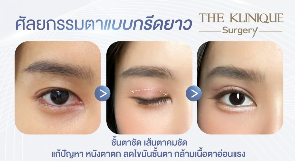 ศัลยกรรมตา, ศัลยกรรมตาสองชั้น, ศัลยกรรมตาสองชั้น ราคา, ศัลยกรรมตาที่ไหนดี, ศัลยกรรมตามีกี่แบบ, ตาสองชั้น, ตาสองชั้นหลบใน, คลินิกทำตา, ตาสองชั้นที่ไหนดี, ตาสองชั้นแบบกรีดสั้น กรีดยาว, กล้ามเนื้อตาอ่อนแรง, แก้ตา, แก้ตาสองชั้น, แก้หนังตาตก, แก้ชั้นตาใหญ่, แก้ตาไม่เท่ากัน, หนังตาตก, แก้หนังตาตก
