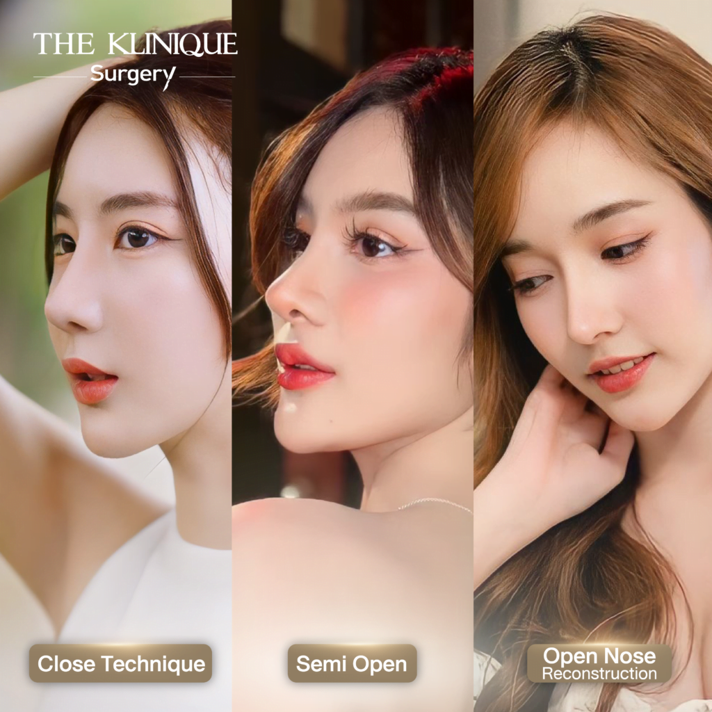 เสริมจมูก, ศัลยกรรมจมูก, ศัลยกรรมจมูก รีวิว, รีวิว เสริมจมูก, ศัลยกรรมจมูกมีกี่แบบ, เสริมจมูกที่ไหนดี, เสริมจมูกโอเพ่น, เสริมจมูกราคา, รีวิวเสริมจมูก, ทำจมูก, ทำจมูก รีวิว, รีวิวทำจมูก, รีวิว ศัลยกรรมจมูก, ซิลิโคนจมูก, แก้จมูก, แก้จมูก รีวิว, รีวิวแก้จมูก, แก้จมูกที่ไหนดี, เสริมจมูก Close, เสริมจมูก semi open, จมูก open, เสริมจมูก Open ที่ไหนดี, รีวิว เสริมจมูก Open, เสริมจมูกโอเพ่น, เสริมจมูกโอเพ่นที่ไหนดี, ทรงจมูก, ทรงจมูกสวย, ทรงจมูกเกาหลี, ทรงจมูกธรรมชาติ, ทรงจมูกสโลปปลายพุ่ง, ทรงจมูกผู้ชาย