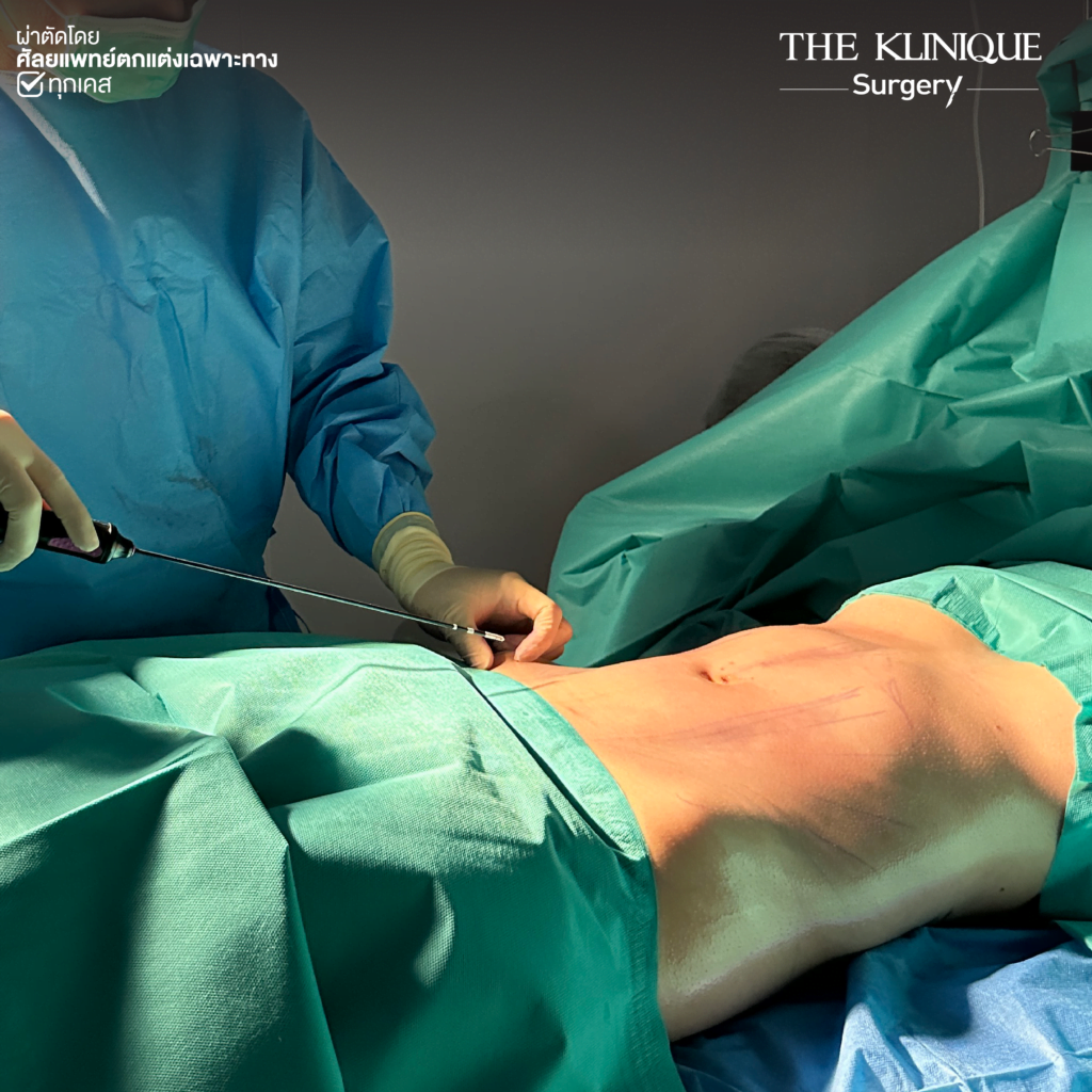 Liposuction, Sculpting,Xshape,Lipo, ศัลยกรรมดูดไขมัน, ดูดไขมัน,คลินิกดูดไขมัน,ดูดไขมันเฉพาะส่วน,ดูดไขมันเหนียง,ดูดไขมันหน้าท้อง,ดูดไขมันรีวิว, รีวิวดูดไขมัน, รีวิวดูดไขมันหน้าท้อง,ดูดไขมันต้นแขน, ดูดไขมันต้นขา,ดูดไขมันน่อง, ลดความอ้วน, ดูดไขมันที่ไหนดี, ดูดไขมันราคา, ดูดไขมันทั้งตัว