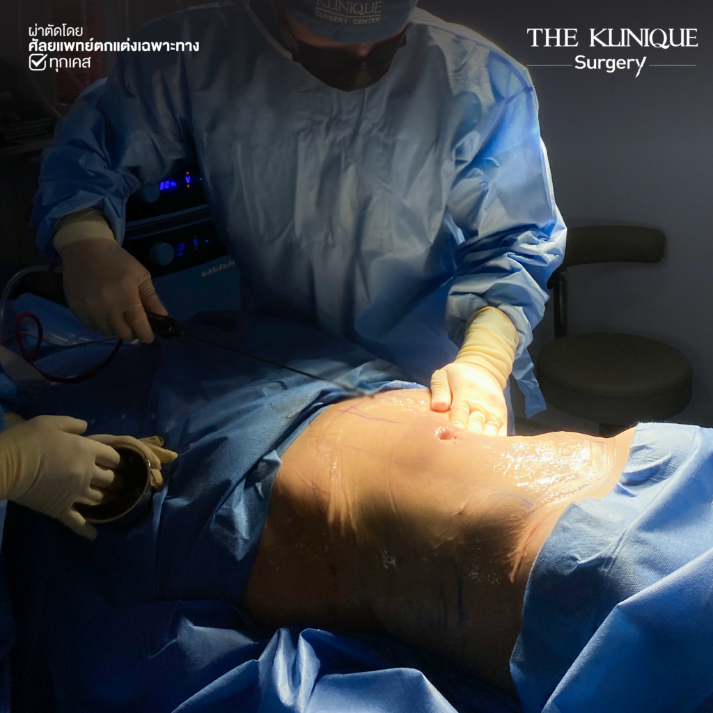 Liposuction, Sculpting,Xshape,Lipo, ศัลยกรรมดูดไขมัน, ดูดไขมัน,คลินิกดูดไขมัน,ดูดไขมันเฉพาะส่วน,ดูดไขมันเหนียง,ดูดไขมันหน้าท้อง,ดูดไขมันรีวิว, รีวิวดูดไขมัน, รีวิวดูดไขมันหน้าท้อง,ดูดไขมันต้นแขน, ดูดไขมันต้นขา,ดูดไขมันน่อง, ลดความอ้วน, ดูดไขมันที่ไหนดี, ดูดไขมันราคา, ดูดไขมันทั้งตัว