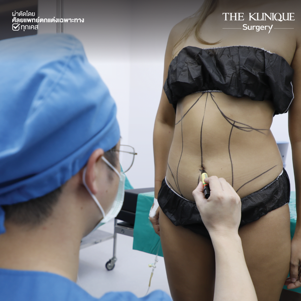 Liposuction, Sculpting,Xshape,Lipo, ศัลยกรรมดูดไขมัน, ดูดไขมัน,คลินิกดูดไขมัน,ดูดไขมันเฉพาะส่วน,ดูดไขมันเหนียง,ดูดไขมันหน้าท้อง,ดูดไขมันรีวิว, รีวิวดูดไขมัน, รีวิวดูดไขมันหน้าท้อง,ดูดไขมันต้นแขน, ดูดไขมันต้นขา,ดูดไขมันน่อง, ลดความอ้วน, ดูดไขมันที่ไหนดี, ดูดไขมันราคา, ดูดไขมันทั้งตัว