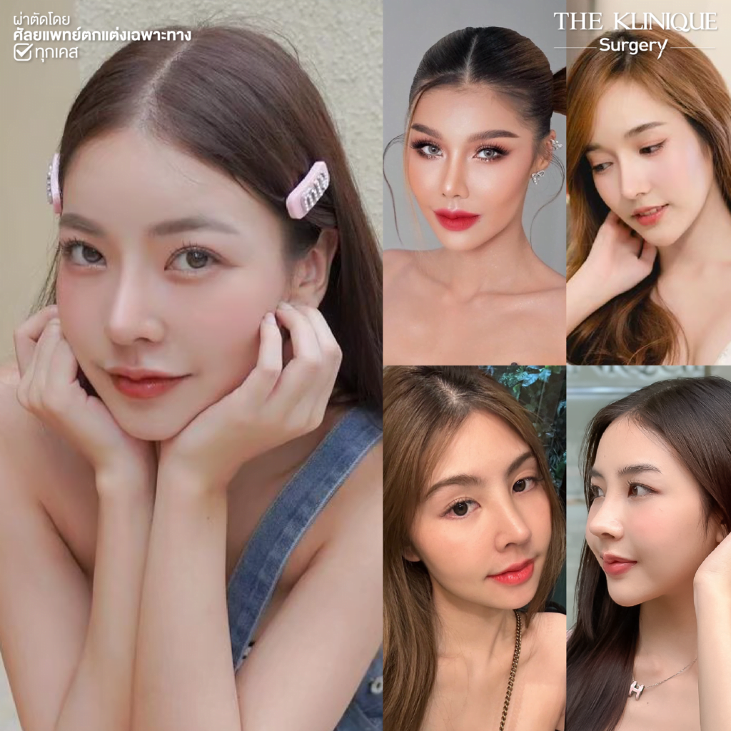 ทรงจมูก, ทรงจมูกสวย, ทรงจมูกเกาหลี, ทรงจมูกธรรมชาติ, ทรงจมูกสันสโลปปลายพุ่ง, ศัลยกรรมจมูก, ศัลยกรรมจมูก รีวิว, เสริมจมูก, เสริมจมูกที่ไหนดี, เสริมจมูกราคา, รีวิว เสริมจมูก, เสริมจมูก รีวิว, ทำจมูก, ทำจมูก รีวิว, เสริมจมูก Close, เสริมจมูก Semi Open, เสริมจมูก Open, เสริมจมูก โอเพ่น, ซิลิโคนจมูก, จมูก Open, รีวิวเสริมจมูกโอเพ่น, รีวิวเสริมจมูก Open