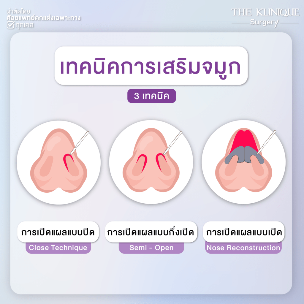 ทรงจมูก, ทรงจมูกสวย, ทรงจมูกเกาหลี, ทรงจมูกธรรมชาติ, ทรงจมูกสันสโลปปลายพุ่ง, ศัลยกรรมจมูก, ศัลยกรรมจมูก รีวิว, เสริมจมูก, เสริมจมูกที่ไหนดี, เสริมจมูกราคา, รีวิว เสริมจมูก, เสริมจมูก รีวิว, ทำจมูก, ทำจมูก รีวิว, เสริมจมูก Close, เสริมจมูก Semi Open, เสริมจมูก Open, เสริมจมูก โอเพ่น, ซิลิโคนจมูก, จมูก Open, รีวิวเสริมจมูกโอเพ่น, รีวิวเสริมจมูก Open