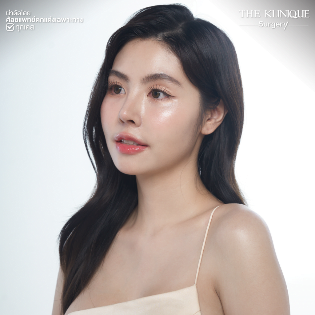 ทรงจมูก, ทรงจมูกสวย, ทรงจมูกเกาหลี, ทรงจมูกธรรมชาติ, ทรงจมูกสันสโลปปลายพุ่ง, ศัลยกรรมจมูก, ศัลยกรรมจมูก รีวิว, เสริมจมูก, เสริมจมูกที่ไหนดี, เสริมจมูกราคา, รีวิว เสริมจมูก, เสริมจมูก รีวิว, ทำจมูก, ทำจมูก รีวิว, เสริมจมูก Close, เสริมจมูก Semi Open, เสริมจมูก Open, เสริมจมูก โอเพ่น, ซิลิโคนจมูก, จมูก Open, รีวิวเสริมจมูกโอเพ่น, รีวิวเสริมจมูก Open
