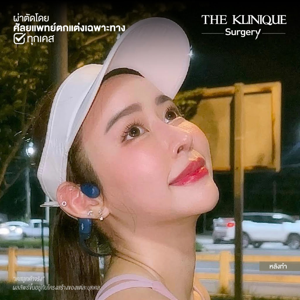 เสริมจมูก, ศัลยกรรมจมูก, ศัลยกรรมจมูก รีวิว, รีวิว เสริมจมูก, ศัลยกรรมจมูกมีกี่แบบ, เสริมจมูกที่ไหนดี, เสริมจมูกโอเพ่น, เสริมจมูกราคา, รีวิวเสริมจมูก, ทำจมูก, ทำจมูก รีวิว, รีวิวทำจมูก, รีวิว ศัลยกรรมจมูก, ซิลิโคนจมูก, แก้จมูก, แก้จมูก รีวิว, รีวิวแก้จมูก, แก้จมูกที่ไหนดี, เสริมจมูก Close, เสริมจมูก semi open, จมูก open, เสริมจมูก Open ที่ไหนดี, รีวิว เสริมจมูก Open, เสริมจมูกโอเพ่น, เสริมจมูกโอเพ่นที่ไหนดี, ทรงจมูก, ทรงจมูกสวย, ทรงจมูกเกาหลี, ทรงจมูกธรรมชาติ, ทรงจมูกสโลปปลายพุ่ง, ทรงจมูกผู้ชาย