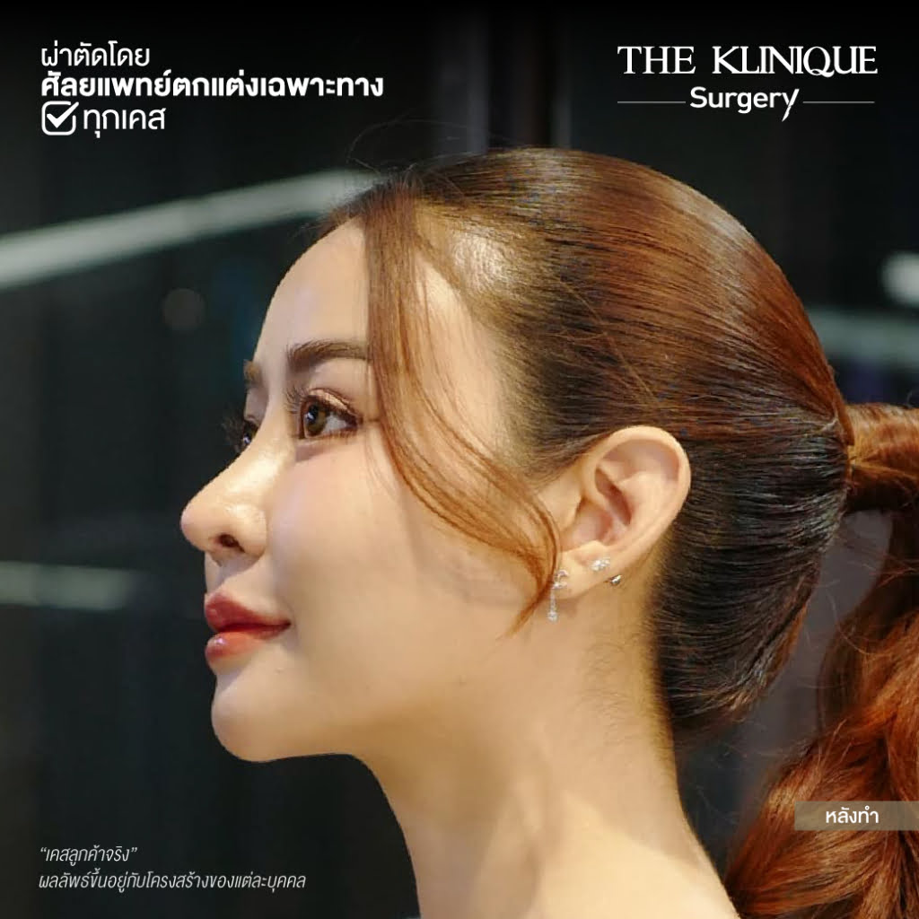 เสริมจมูก, ศัลยกรรมจมูก, ศัลยกรรมจมูก รีวิว, รีวิว เสริมจมูก, ศัลยกรรมจมูกมีกี่แบบ, เสริมจมูกที่ไหนดี, เสริมจมูกโอเพ่น, เสริมจมูกราคา, รีวิวเสริมจมูก, ทำจมูก, ทำจมูก รีวิว, รีวิวทำจมูก, รีวิว ศัลยกรรมจมูก, ซิลิโคนจมูก, แก้จมูก, แก้จมูก รีวิว, รีวิวแก้จมูก, แก้จมูกที่ไหนดี, เสริมจมูก Close, เสริมจมูก semi open, จมูก open, เสริมจมูก Open ที่ไหนดี, รีวิว เสริมจมูก Open, เสริมจมูกโอเพ่น, เสริมจมูกโอเพ่นที่ไหนดี, ทรงจมูก, ทรงจมูกสวย, ทรงจมูกเกาหลี, ทรงจมูกธรรมชาติ, ทรงจมูกสโลปปลายพุ่ง, ทรงจมูกผู้ชาย