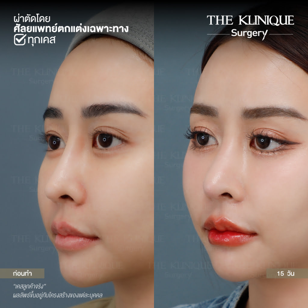 เสริมจมูก, ศัลยกรรมจมูก, ศัลยกรรมจมูก รีวิว, รีวิว เสริมจมูก, ศัลยกรรมจมูกมีกี่แบบ, เสริมจมูกที่ไหนดี, เสริมจมูกโอเพ่น, เสริมจมูกราคา, รีวิวเสริมจมูก, ทำจมูก, ทำจมูก รีวิว, รีวิวทำจมูก, รีวิว ศัลยกรรมจมูก, ซิลิโคนจมูก, แก้จมูก, แก้จมูก รีวิว, รีวิวแก้จมูก, แก้จมูกที่ไหนดี, เสริมจมูก Close, เสริมจมูก semi open, จมูก open, เสริมจมูก Open ที่ไหนดี, รีวิว เสริมจมูก Open, เสริมจมูกโอเพ่น, เสริมจมูกโอเพ่นที่ไหนดี, ทรงจมูก, ทรงจมูกสวย, ทรงจมูกเกาหลี, ทรงจมูกธรรมชาติ, ทรงจมูกสโลปปลายพุ่ง, ทรงจมูกผู้ชาย
