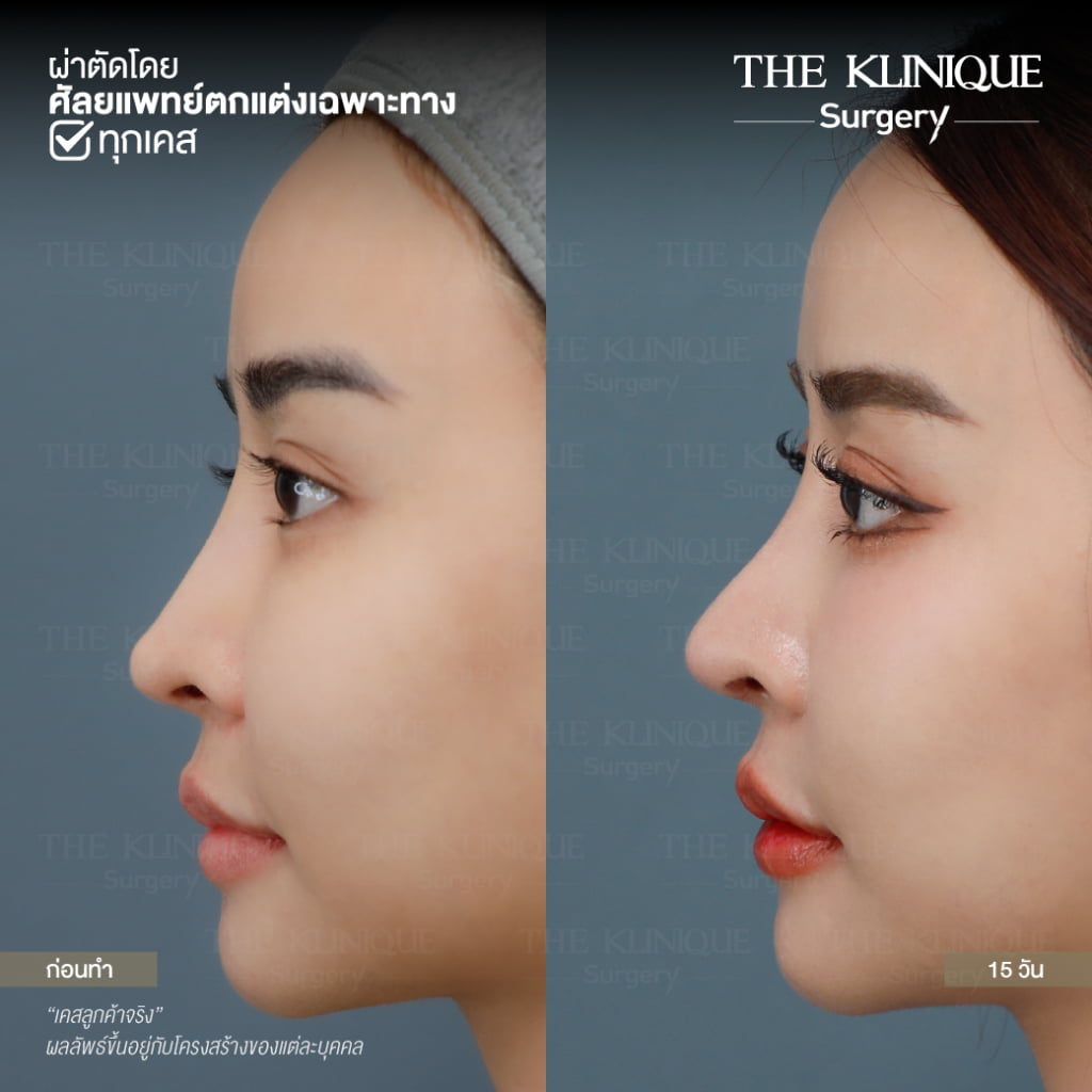 เสริมจมูก, ศัลยกรรมจมูก, ศัลยกรรมจมูก รีวิว, รีวิว เสริมจมูก, ศัลยกรรมจมูกมีกี่แบบ, เสริมจมูกที่ไหนดี, เสริมจมูกโอเพ่น, เสริมจมูกราคา, รีวิวเสริมจมูก, ทำจมูก, ทำจมูก รีวิว, รีวิวทำจมูก, รีวิว ศัลยกรรมจมูก, ซิลิโคนจมูก, แก้จมูก, แก้จมูก รีวิว, รีวิวแก้จมูก, แก้จมูกที่ไหนดี, เสริมจมูก Close, เสริมจมูก semi open, จมูก open, เสริมจมูก Open ที่ไหนดี, รีวิว เสริมจมูก Open, เสริมจมูกโอเพ่น, เสริมจมูกโอเพ่นที่ไหนดี, ทรงจมูก, ทรงจมูกสวย, ทรงจมูกเกาหลี, ทรงจมูกธรรมชาติ, ทรงจมูกสโลปปลายพุ่ง, ทรงจมูกผู้ชาย
