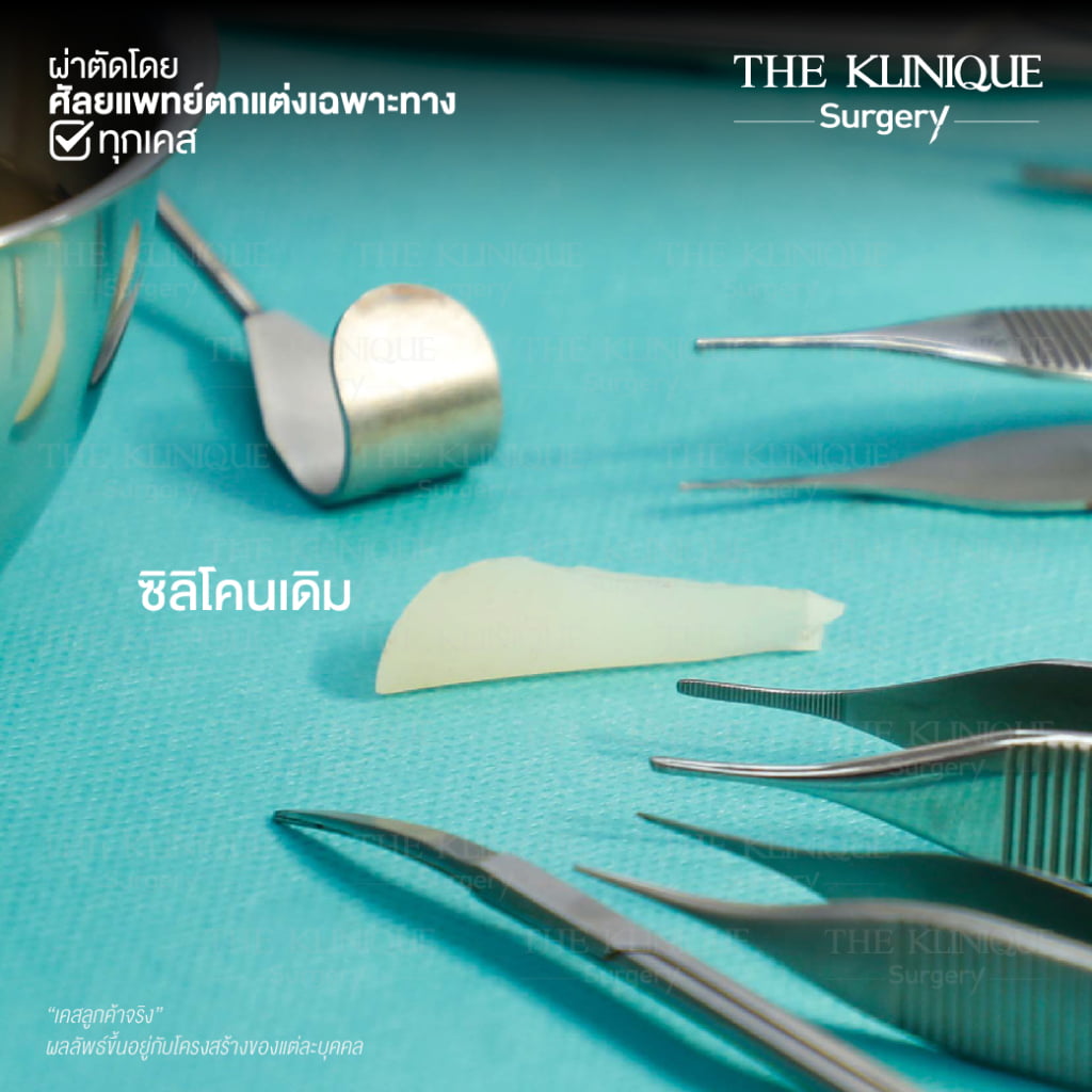 เสริมจมูก, ศัลยกรรมจมูก, ศัลยกรรมจมูก รีวิว, รีวิว เสริมจมูก, ศัลยกรรมจมูกมีกี่แบบ, เสริมจมูกที่ไหนดี, เสริมจมูกโอเพ่น, เสริมจมูกราคา, รีวิวเสริมจมูก, ทำจมูก, ทำจมูก รีวิว, รีวิวทำจมูก, รีวิว ศัลยกรรมจมูก, ซิลิโคนจมูก, แก้จมูก, แก้จมูก รีวิว, รีวิวแก้จมูก, แก้จมูกที่ไหนดี, เสริมจมูก Close, เสริมจมูก semi open, จมูก open, เสริมจมูก Open ที่ไหนดี, รีวิว เสริมจมูก Open, เสริมจมูกโอเพ่น, เสริมจมูกโอเพ่นที่ไหนดี, ทรงจมูก, ทรงจมูกสวย, ทรงจมูกเกาหลี, ทรงจมูกธรรมชาติ, ทรงจมูกสโลปปลายพุ่ง, ทรงจมูกผู้ชาย