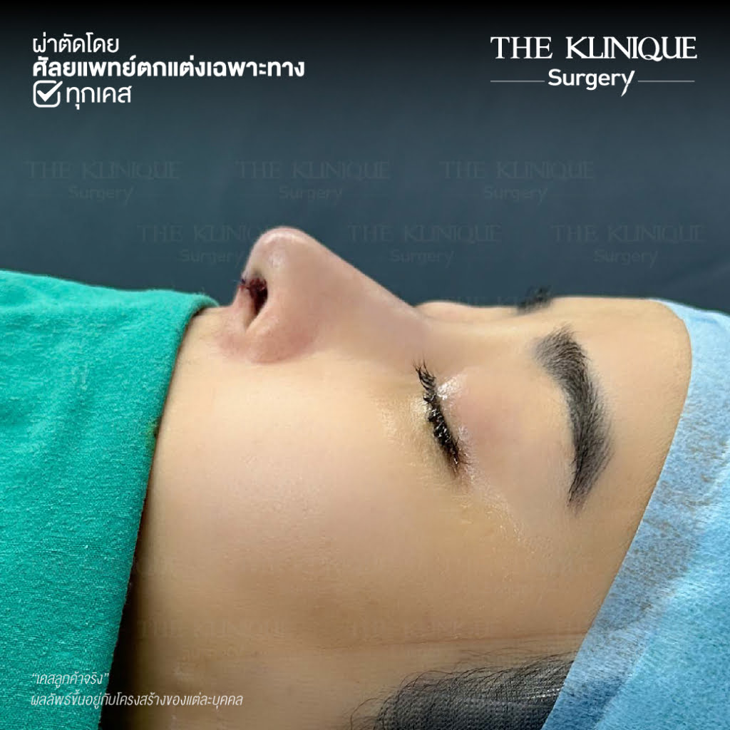 เสริมจมูก, ศัลยกรรมจมูก, ศัลยกรรมจมูก รีวิว, รีวิว เสริมจมูก, ศัลยกรรมจมูกมีกี่แบบ, เสริมจมูกที่ไหนดี, เสริมจมูกโอเพ่น, เสริมจมูกราคา, รีวิวเสริมจมูก, ทำจมูก, ทำจมูก รีวิว, รีวิวทำจมูก, รีวิว ศัลยกรรมจมูก, ซิลิโคนจมูก, แก้จมูก, แก้จมูก รีวิว, รีวิวแก้จมูก, แก้จมูกที่ไหนดี, เสริมจมูก Close, เสริมจมูก semi open, จมูก open, เสริมจมูก Open ที่ไหนดี, รีวิว เสริมจมูก Open, เสริมจมูกโอเพ่น, เสริมจมูกโอเพ่นที่ไหนดี, ทรงจมูก, ทรงจมูกสวย, ทรงจมูกเกาหลี, ทรงจมูกธรรมชาติ, ทรงจมูกสโลปปลายพุ่ง, ทรงจมูกผู้ชาย