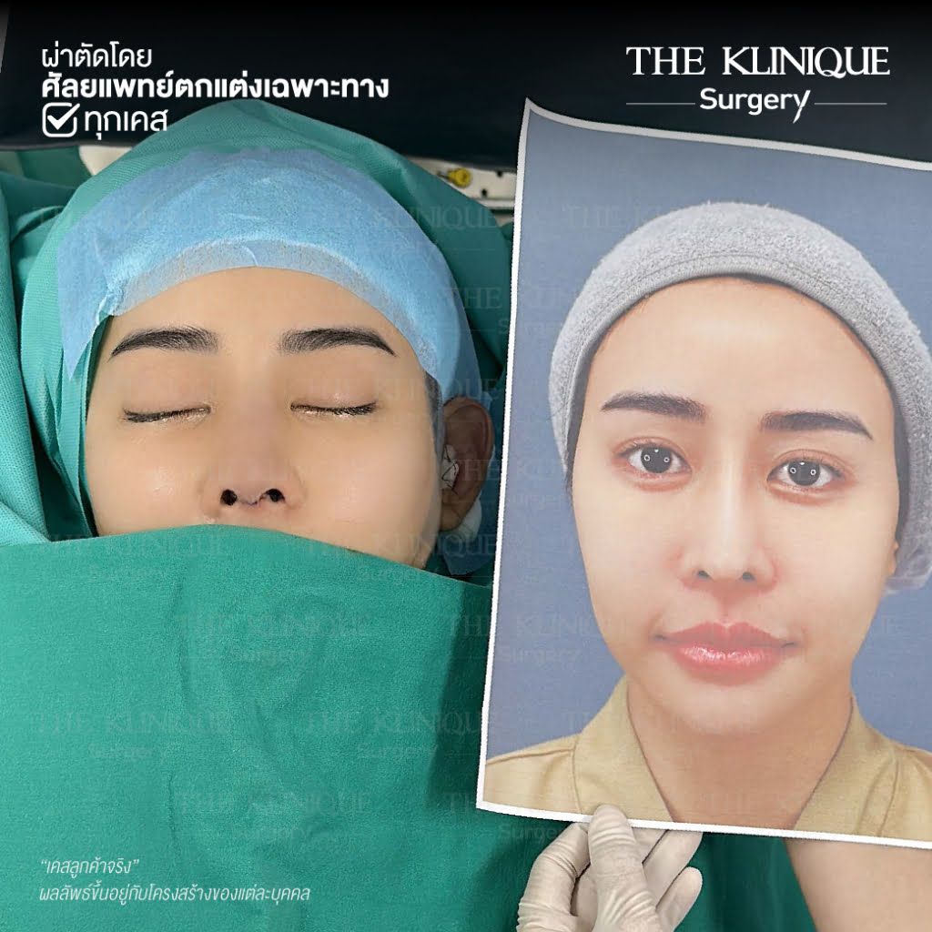 เสริมจมูก, ศัลยกรรมจมูก, ศัลยกรรมจมูก รีวิว, รีวิว เสริมจมูก, ศัลยกรรมจมูกมีกี่แบบ, เสริมจมูกที่ไหนดี, เสริมจมูกโอเพ่น, เสริมจมูกราคา, รีวิวเสริมจมูก, ทำจมูก, ทำจมูก รีวิว, รีวิวทำจมูก, รีวิว ศัลยกรรมจมูก, ซิลิโคนจมูก, แก้จมูก, แก้จมูก รีวิว, รีวิวแก้จมูก, แก้จมูกที่ไหนดี, เสริมจมูก Close, เสริมจมูก semi open, จมูก open, เสริมจมูก Open ที่ไหนดี, รีวิว เสริมจมูก Open, เสริมจมูกโอเพ่น, เสริมจมูกโอเพ่นที่ไหนดี, ทรงจมูก, ทรงจมูกสวย, ทรงจมูกเกาหลี, ทรงจมูกธรรมชาติ, ทรงจมูกสโลปปลายพุ่ง, ทรงจมูกผู้ชาย