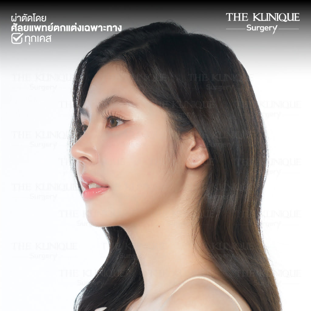 ทรงจมูก, ทรงจมูกสวย, ทรงจมูกเกาหลี, ทรงจมูกธรรมชาติ, ทรงจมูกสันสโลปปลายพุ่ง, ศัลยกรรมจมูก, เสริมจมูก, เสริมจมูกที่ไหนดี, เสริมจมูกราคา, รีวิว เสริมจมูก, ทำจมูก, ทำจมูก รีวิว,เสริมจมูก Semi Open, เสริมจมูก Open, เสริมจมูก โอเพ่น, ซิลิโคนจมูก, จมูกOpen, รีวิวเสริมจมูกโอเพ่น, รีวิวเสริมจมูก Open