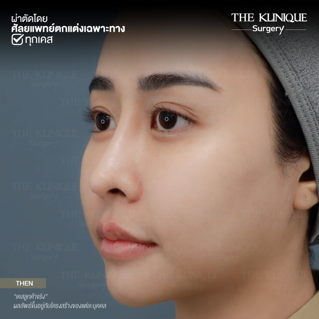ทรงจมูก, ทรงจมูกสวย, ทรงจมูกเกาหลี, ทรงจมูกธรรมชาติ, ทรงจมูกสันสโลปปลายพุ่ง, ศัลยกรรมจมูก, เสริมจมูก, เสริมจมูกที่ไหนดี, เสริมจมูกราคา, รีวิว เสริมจมูก, ทำจมูก, ทำจมูก รีวิว,เสริมจมูก Semi Open, เสริมจมูก Open, เสริมจมูก โอเพ่น, ซิลิโคนจมูก, จมูกOpen, รีวิวเสริมจมูกโอเพ่น, รีวิวเสริมจมูก Open