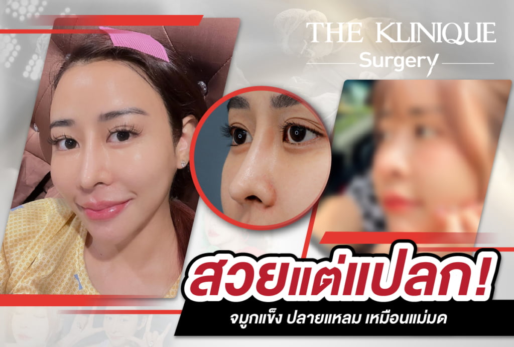 เสริมจมูก, ศัลยกรรมจมูก, ศัลยกรรมจมูก รีวิว, รีวิว เสริมจมูก, ศัลยกรรมจมูกมีกี่แบบ, เสริมจมูกที่ไหนดี, เสริมจมูกโอเพ่น, เสริมจมูกราคา, รีวิวเสริมจมูก, ทำจมูก, ทำจมูก รีวิว, รีวิวทำจมูก, รีวิว ศัลยกรรมจมูก, ซิลิโคนจมูก, แก้จมูก, แก้จมูก รีวิว, รีวิวแก้จมูก, แก้จมูกที่ไหนดี, เสริมจมูก Close, เสริมจมูก semi open, จมูก open, เสริมจมูก Open ที่ไหนดี, รีวิว เสริมจมูก Open, เสริมจมูกโอเพ่น, เสริมจมูกโอเพ่นที่ไหนดี, ทรงจมูก, ทรงจมูกสวย, ทรงจมูกเกาหลี, ทรงจมูกธรรมชาติ, ทรงจมูกสโลปปลายพุ่ง, ทรงจมูกผู้ชาย
