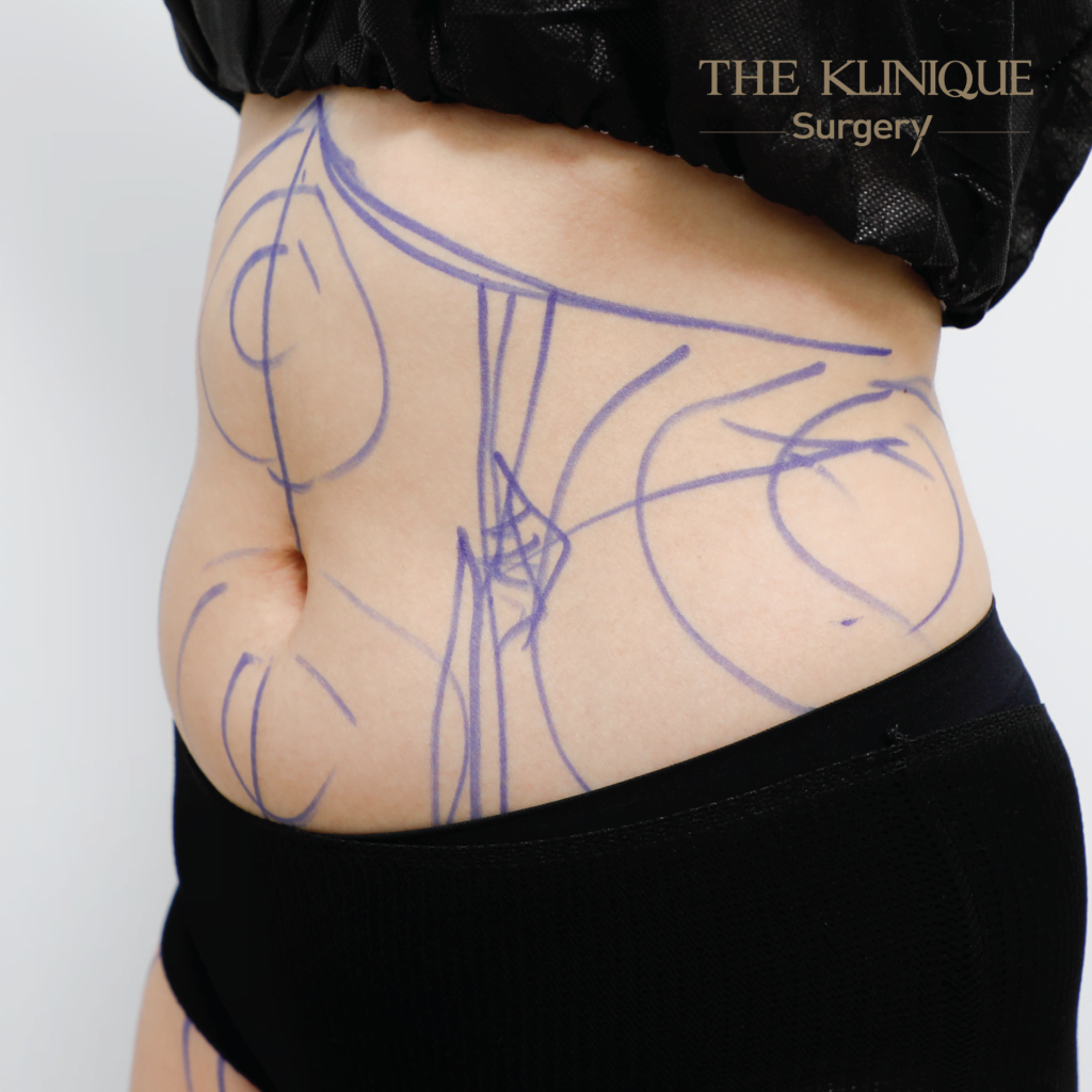 Liposuction, Sculpting,Xshape,Lipo, ศัลยกรรมดูดไขมัน, ดูดไขมัน,คลินิกดูดไขมัน,ดูดไขมันเฉพาะส่วน,ดูดไขมันเหนียง,ดูดไขมันหน้าท้อง,ดูดไขมันรีวิว, รีวิวดูดไขมัน, รีวิวดูดไขมันหน้าท้อง,ดูดไขมันต้นแขน, ดูดไขมันต้นขา,ดูดไขมันน่อง, ลดความอ้วน, ดูดไขมันที่ไหนดี, ดูดไขมันราคา, ดูดไขมันทั้งตัว