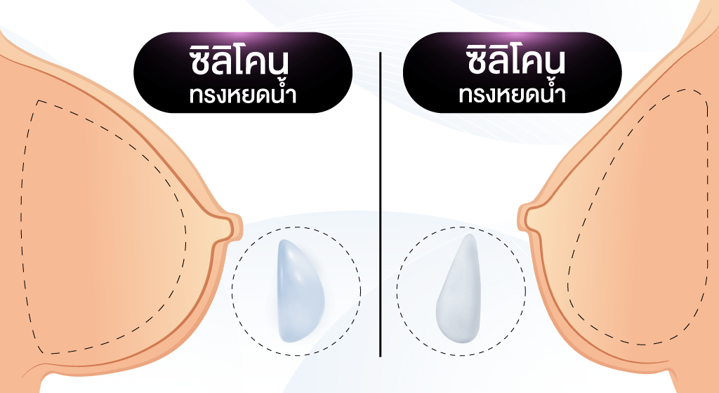 เสริมหน้าอก, ศัลยกรรมหน้าอก, เสริมหน้าอกที่ไหนดี, แก้หน้าอก, แก้หน้าอกที่ไหนดี, เสริมหน้าอกราคา, แก้หน้าอก ราคา, รีวิวแก้หน้าอก, รีวิวเสริมหน้าอก, แก้หน้าอกไม่เท่ากัน, ทำหน้าอก, ทำนม, ซิลิโคนหน้าอก