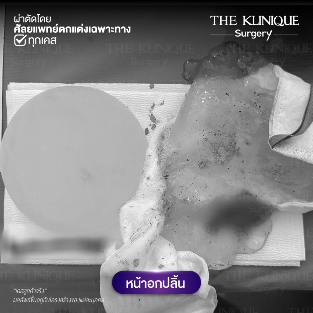 ทำหน้าอก, เสริมหน้าอก, ศัลยกรรมหน้าอก, เสริมหน้าอกที่ไหนดี, แก้หน้าอก, แก้หน้าอกที่ไหนดี, เสริมหน้าอกราคา, แก้หน้าอก ราคา, รีวิวแก้หน้าอก, รีวิวเสริมหน้าอก, แก้หน้าอกไม่เท่ากัน, ทำหน้าอก, ทำนม, ซิลิโคนหน้าอก