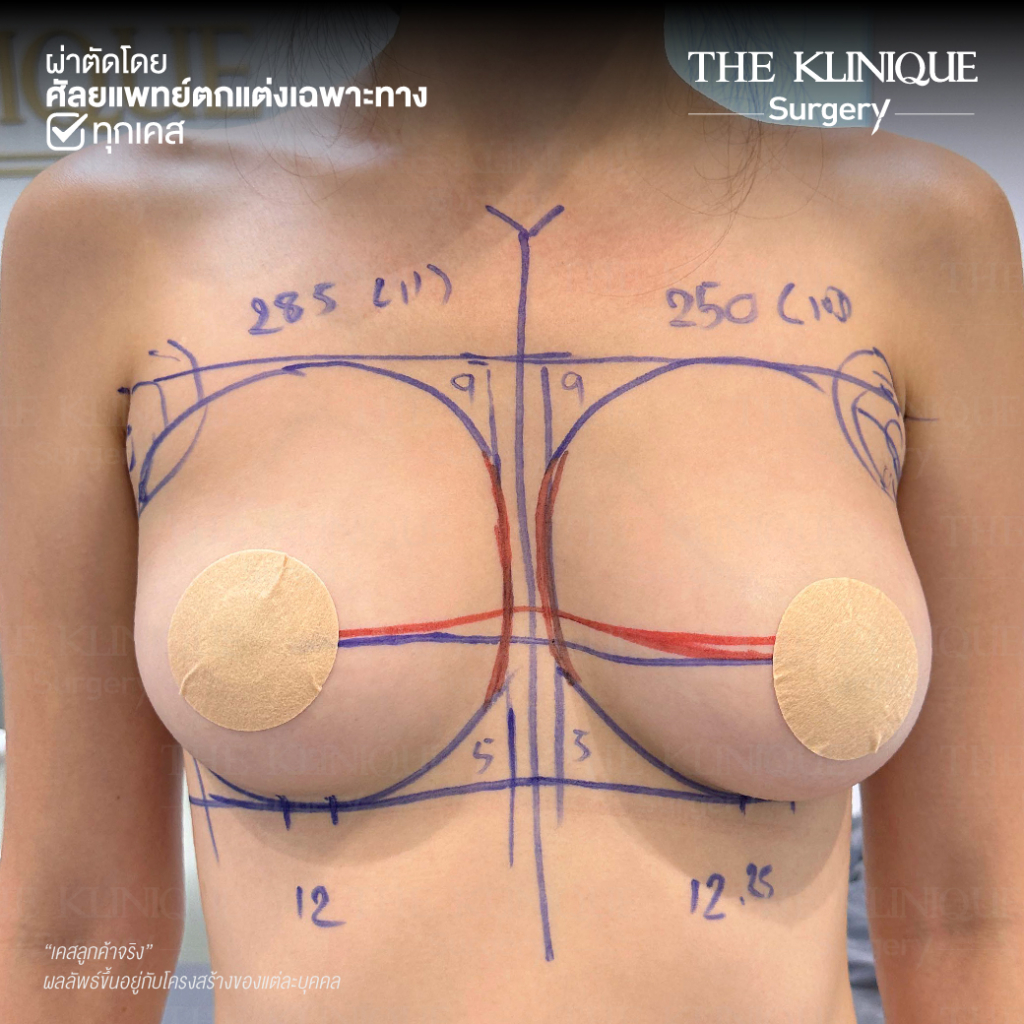 ทำหน้าอก, เสริมหน้าอก, ศัลยกรรมหน้าอก, เสริมหน้าอกที่ไหนดี, แก้หน้าอก, แก้หน้าอกที่ไหนดี, เสริมหน้าอกราคา, แก้หน้าอก ราคา, รีวิวแก้หน้าอก, รีวิวเสริมหน้าอก, แก้หน้าอกไม่เท่ากัน, ทำหน้าอก, ทำนม, ซิลิโคนหน้าอก