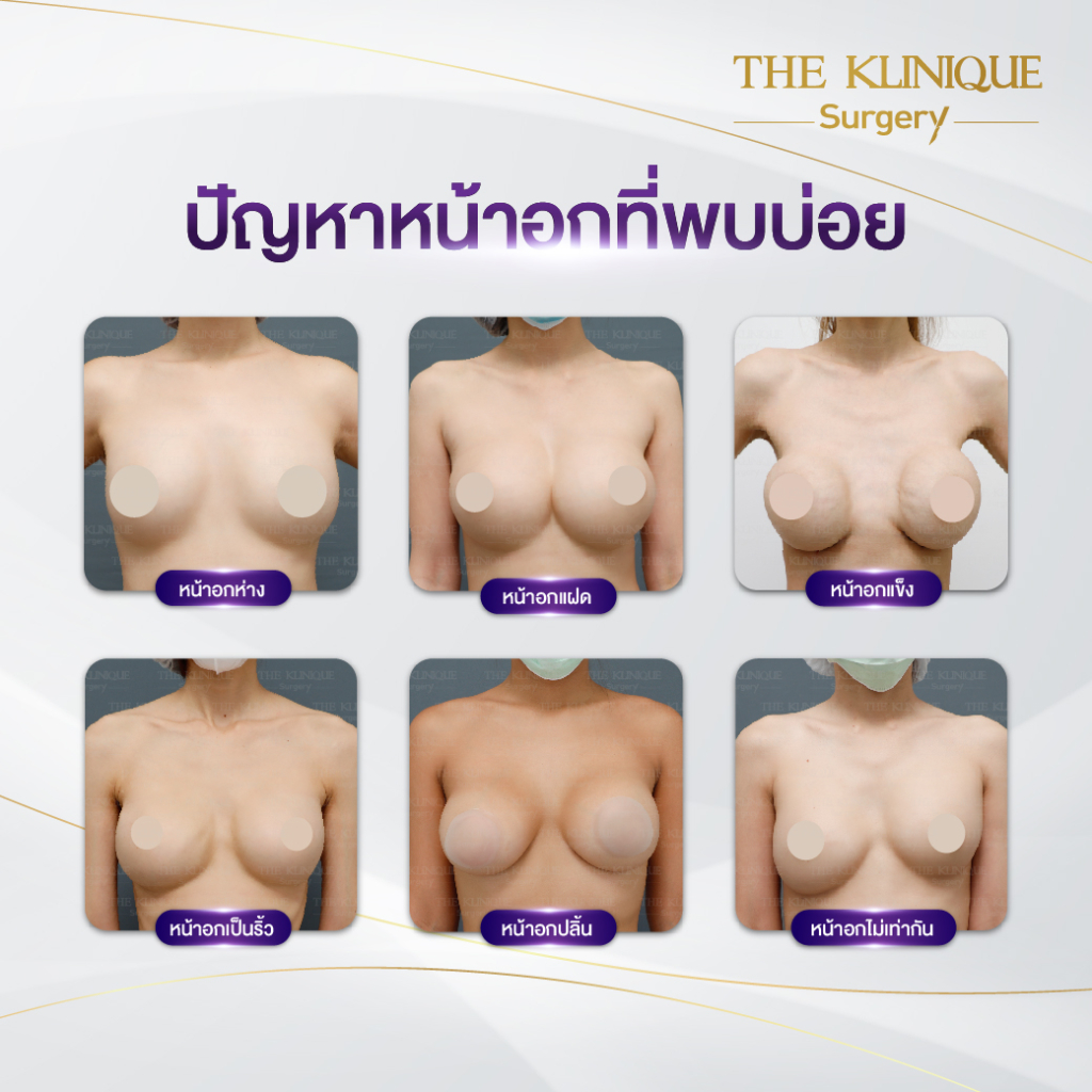 ทำหน้าอก, เสริมหน้าอก, ศัลยกรรมหน้าอก, เสริมหน้าอกที่ไหนดี, แก้หน้าอก, แก้หน้าอกที่ไหนดี, เสริมหน้าอกราคา, แก้หน้าอก ราคา, รีวิวแก้หน้าอก, รีวิวเสริมหน้าอก, แก้หน้าอกไม่เท่ากัน, ทำหน้าอก, ทำนม, ซิลิโคนหน้าอก