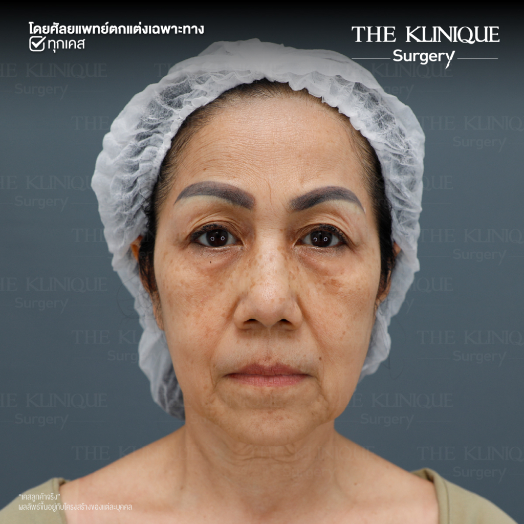 ดึงหน้าดารา, ดึงหน้าย้อนวัย, Facelift, ดึงหน้า ดึงคอ, ดึงหน้า Facelift,ดึงหน้า, ศัลยกรรมดึงหน้า, ดึงหน้า Face Lock, Face Lock, HollyWood Face Lock, เฟซล็อก, เฟซล็อค, เฟสล็อก, เฟสล็อค, ดึงหน้าเฟซล็อค, ดึงหน้าย้อนวัน, ดึงหน้ายกกระชับ, ยกกระชับผิว, หน้าเด็ก, ดึงหน้าที่ไหนดี, ผ่าตัดดึงหน้า, ผ้าตัดส่องกล้อง, ดึงหน้า ซ่อนแผล