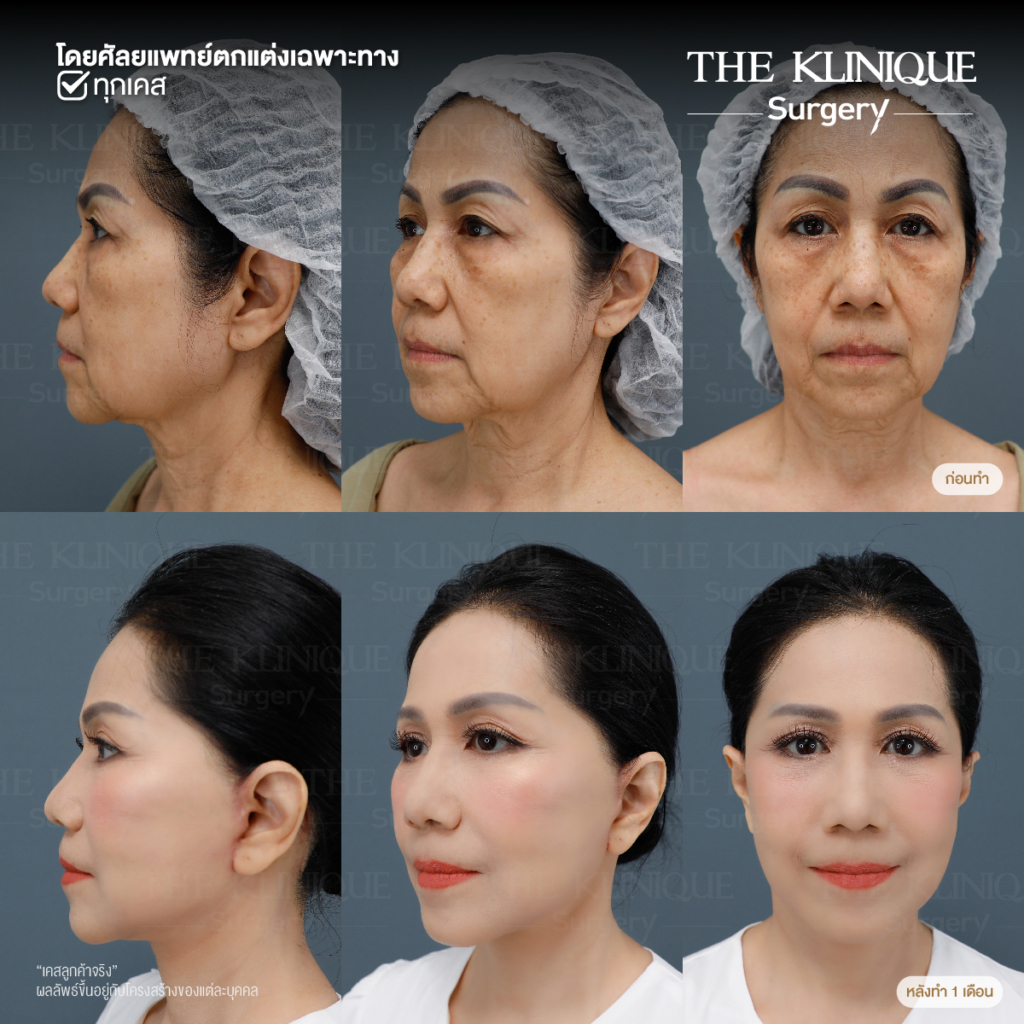 ดึงหน้าดารา, ดึงหน้าย้อนวัย, Facelift, ดึงหน้า ดึงคอ, ดึงหน้า Facelift, ดึงหน้า, ศัลยกรรมดึงหน้า, ดึงหน้า Face Lock, Face Lock, HollyWood Face Lock, เฟซล็อก, เฟซล็อค, เฟสล็อก, เฟสล็อค, ดึงหน้าเฟซล็อค, ดึงหน้าย้อนวัน, ดึงหน้ายกกระชับ, ยกกระชับผิว, หน้าเด็ก, ดึงหน้าที่ไหนดี, ผ่าตัดดึงหน้า, ผ้าตัดส่องกล้อง, ดึงหน้า ซ่อนแผล