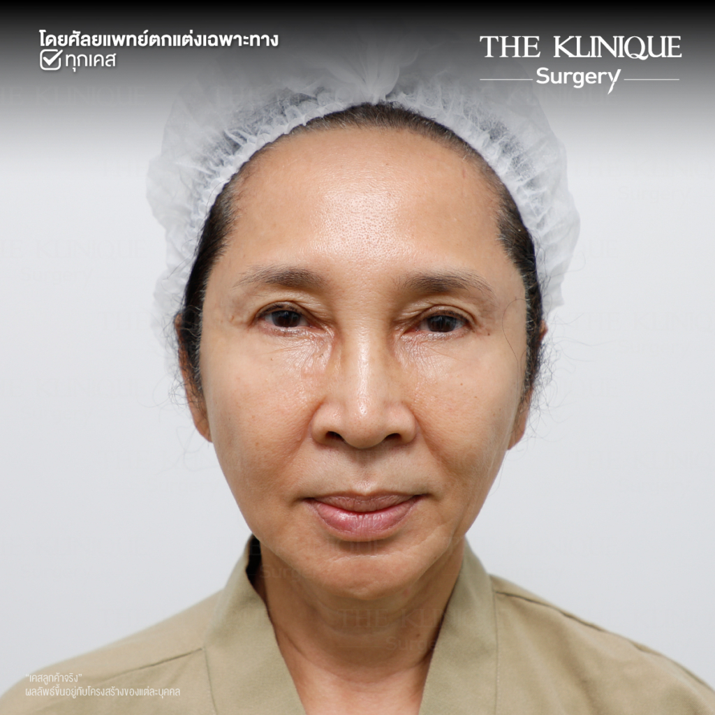 ดึงหน้าดารา, ดึงหน้าย้อนวัย, Facelift, ดึงหน้า ดึงคอ, ดึงหน้า Facelift, ดึงหน้า, ศัลยกรรมดึงหน้า, ดึงหน้า Face Lock, Face Lock, HollyWood Face Lock, เฟซล็อก, เฟซล็อค, เฟสล็อก, เฟสล็อค, ดึงหน้าเฟซล็อค, ดึงหน้าย้อนวัน, ดึงหน้ายกกระชับ, ยกกระชับผิว, หน้าเด็ก, ดึงหน้าที่ไหนดี, ผ่าตัดดึงหน้า, ผ้าตัดส่องกล้อง, ดึงหน้า ซ่อนแผล