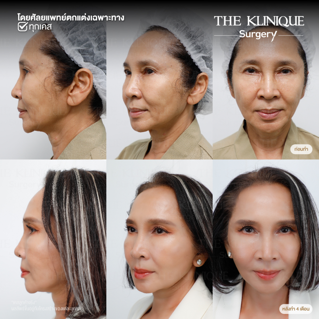 ดึงหน้าดารา, ดึงหน้าย้อนวัย, Facelift, ดึงหน้า ดึงคอ, ดึงหน้า Facelift, ดึงหน้า, ศัลยกรรมดึงหน้า, ดึงหน้า Face Lock, Face Lock, HollyWood Face Lock, เฟซล็อก, เฟซล็อค, เฟสล็อก, เฟสล็อค, ดึงหน้าเฟซล็อค, ดึงหน้าย้อนวัน, ดึงหน้ายกกระชับ, ยกกระชับผิว, หน้าเด็ก, ดึงหน้าที่ไหนดี, ผ่าตัดดึงหน้า, ผ้าตัดส่องกล้อง, ดึงหน้า ซ่อนแผล