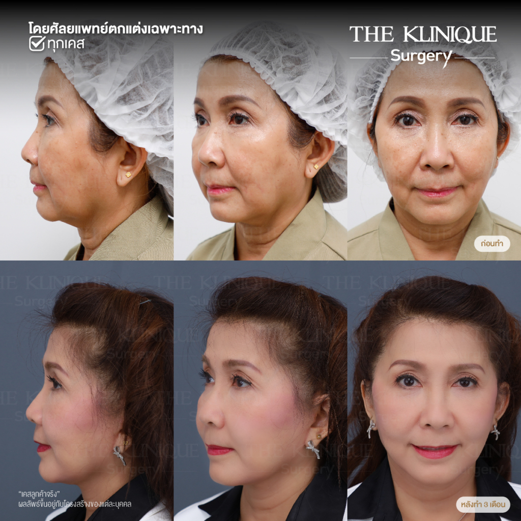 ดึงหน้าดารา, ดึงหน้าย้อนวัย, Facelift, ดึงหน้า ดึงคอ, ดึงหน้า Facelift,  ดึงหน้า, ศัลยกรรมดึงหน้า, ดึงหน้า Face Lock, Face Lock, HollyWood Face Lock, เฟซล็อก, เฟซล็อค, เฟสล็อก, เฟสล็อค, ดึงหน้าเฟซล็อค, ดึงหน้าย้อนวัน, ดึงหน้ายกกระชับ, ยกกระชับผิว, หน้าเด็ก, ดึงหน้าที่ไหนดี, ผ่าตัดดึงหน้า, ผ้าตัดส่องกล้อง, ดึงหน้า ซ่อนแผล