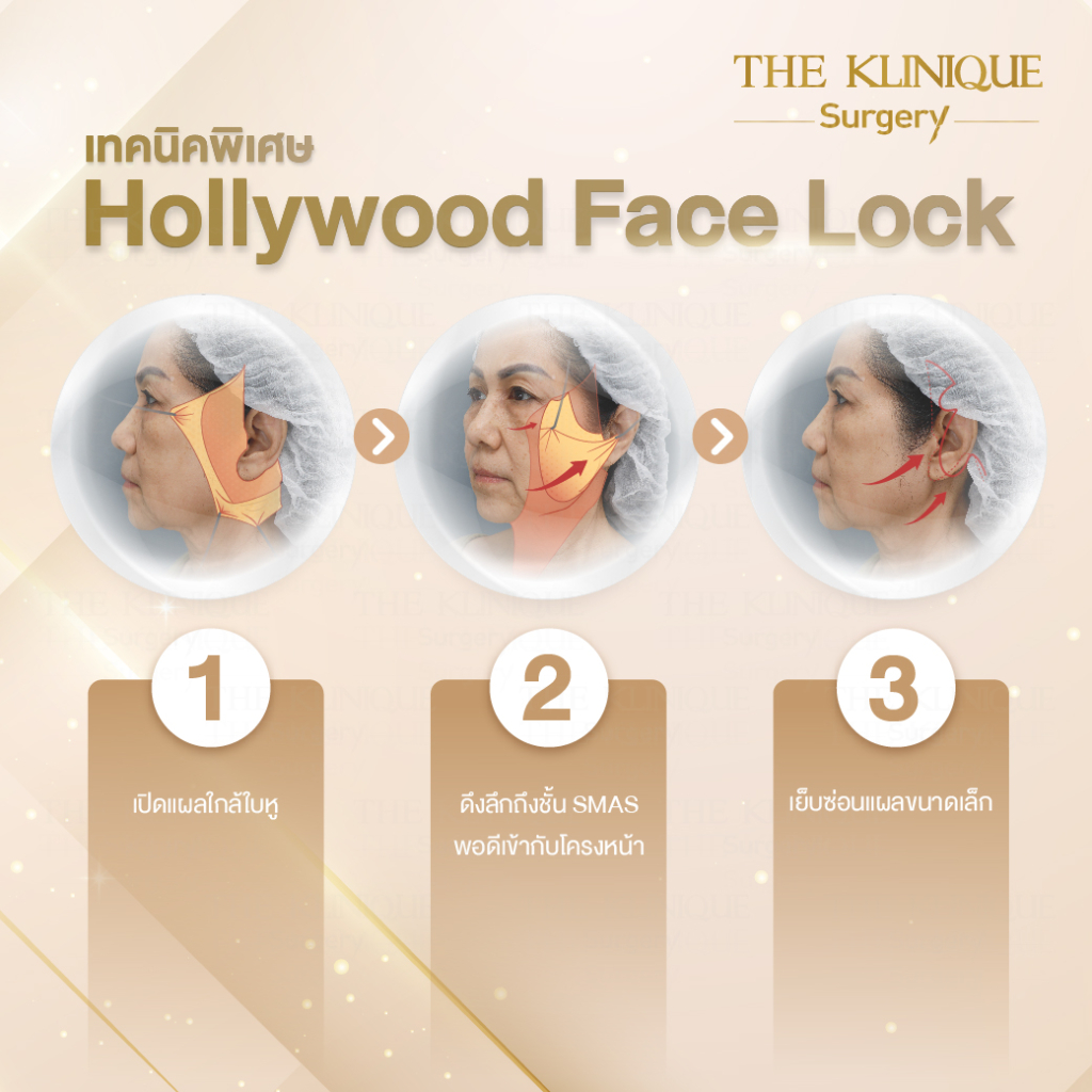ดึงหน้าดารา, ดึงหน้าย้อนวัย, Facelift, ดึงหน้า ดึงคอ, ดึงหน้า Facelift, ดึงหน้า, ศัลยกรรมดึงหน้า, ดึงหน้า Face Lock, Face Lock, HollyWood Face Lock, เฟซล็อก, เฟซล็อค, เฟสล็อก, เฟสล็อค, ดึงหน้าเฟซล็อค, ดึงหน้าย้อนวัน, ดึงหน้ายกกระชับ, ยกกระชับผิว, หน้าเด็ก, ดึงหน้าที่ไหนดี, ผ่าตัดดึงหน้า, ผ้าตัดส่องกล้อง, ดึงหน้า ซ่อนแผล