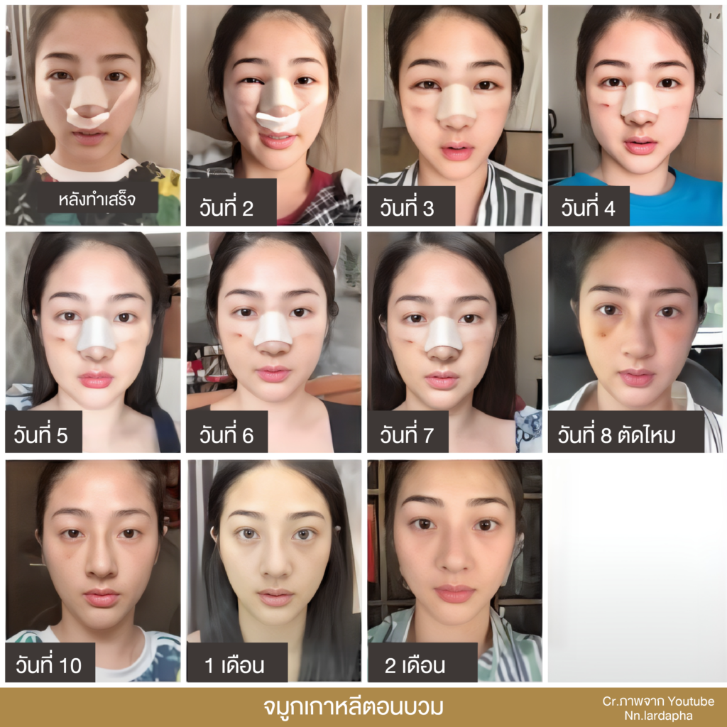 เสริมจมูก, ศัลยกรรมจมูก, ศัลยกรรมจมูก รีวิว, รีวิว เสริมจมูก, ศัลยกรรมจมูกมีกี่แบบ, เสริมจมูกที่ไหนดี, เสริมจมูกโอเพ่น, เสริมจมูกราคา, รีวิวเสริมจมูก, ทำจมูก, ทำจมูก รีวิว, รีวิวทำจมูก, รีวิว ศัลยกรรมจมูก, ซิลิโคนจมูก, แก้จมูก, แก้จมูก รีวิว, รีวิวแก้จมูก, แก้จมูกที่ไหนดี, เสริมจมูก Close, เสริมจมูก semi open, จมูก open, เสริมจมูก Open ที่ไหนดี, รีวิว เสริมจมูก Open, เสริมจมูกโอเพ่น, เสริมจมูกโอเพ่นที่ไหนดี, ทรงจมูก, ทรงจมูกสวย, ทรงจมูกเกาหลี, ทรงจมูกธรรมชาติ, ทรงจมูกสโลปปลายพุ่ง, ทรงจมูกผู้ชาย