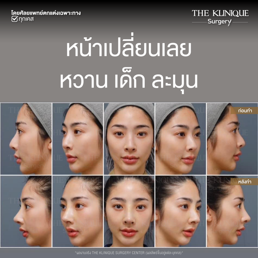 เสริมจมูก, ศัลยกรรมจมูก, ศัลยกรรมจมูก รีวิว, รีวิว เสริมจมูก, ศัลยกรรมจมูกมีกี่แบบ, เสริมจมูกที่ไหนดี, เสริมจมูกโอเพ่น, เสริมจมูกราคา, รีวิวเสริมจมูก, ทำจมูก, ทำจมูก รีวิว, รีวิวทำจมูก, รีวิว ศัลยกรรมจมูก, ซิลิโคนจมูก, แก้จมูก, แก้จมูก รีวิว, รีวิวแก้จมูก, แก้จมูกที่ไหนดี, เสริมจมูก Close, เสริมจมูก semi open, จมูก open, เสริมจมูก Open ที่ไหนดี, รีวิว เสริมจมูก Open, เสริมจมูกโอเพ่น, เสริมจมูกโอเพ่นที่ไหนดี, ทรงจมูก, ทรงจมูกสวย, ทรงจมูกเกาหลี, ทรงจมูกธรรมชาติ, ทรงจมูกสโลปปลายพุ่ง, ทรงจมูกผู้ชาย