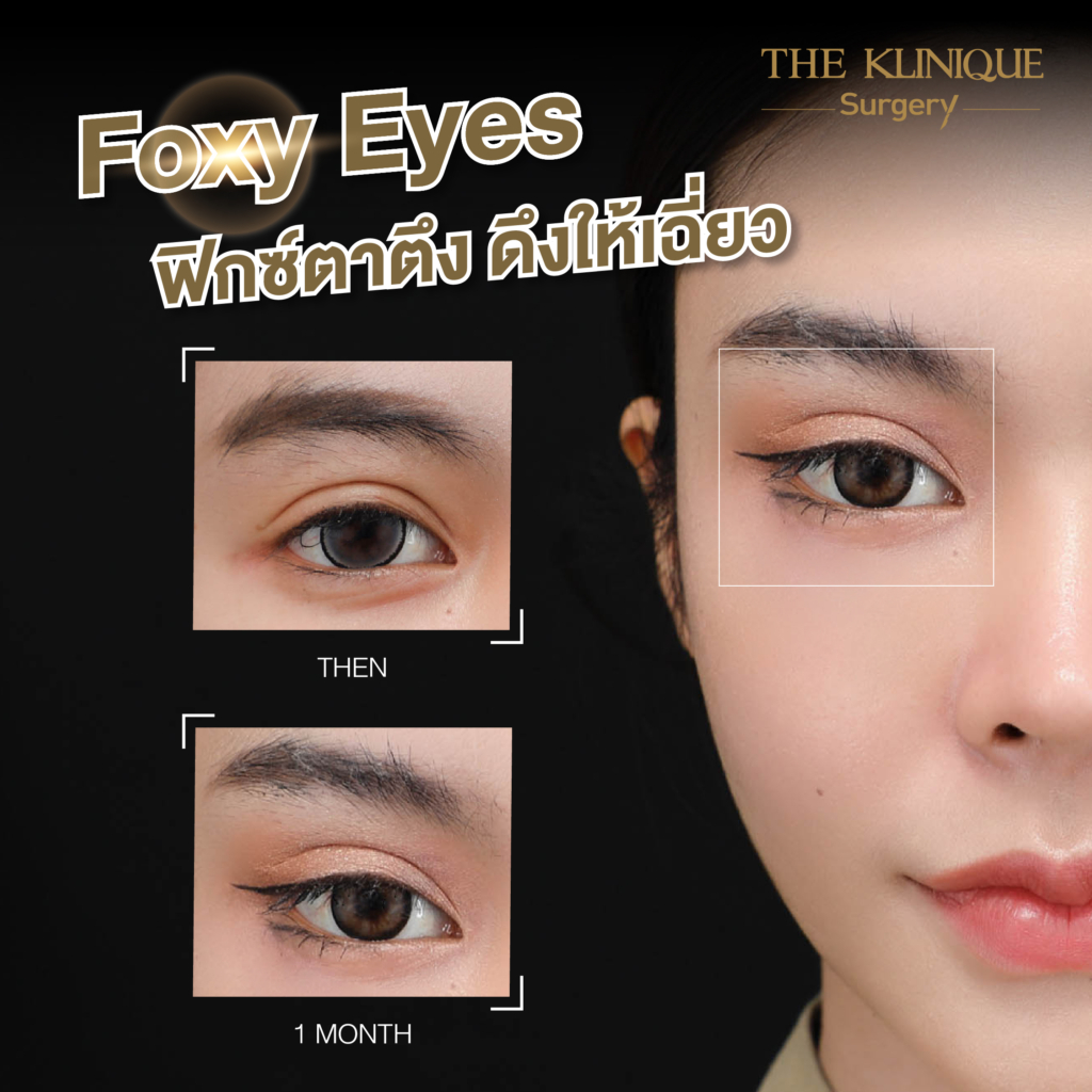 Foxy Eyes, ศัลยกรรมตา, ตาสองชั้น, คลินิกทำตา, ทำตาสองชั้น. ทำตา2ชั้น, กล้ามเนื้อตาอ่อนแรง, แก้ตา, แก้หนังตาตก,หางตาตก, ตาตก,ยกหางตา, แก้ตา, แก้ตาสองชั้น, แก้หนังตาตก , แก้ตาไม่เท่ากัน ,หนังตาตก,แก้หนังตาตก