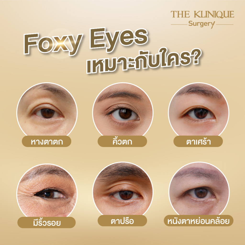 Foxy Eyes, ศัลยกรรมตา, ตาสองชั้น, คลินิกทำตา, ทำตาสองชั้น. ทำตา2ชั้น, กล้ามเนื้อตาอ่อนแรง, แก้ตา, แก้หนังตาตก,หางตาตก, ตาตก,ยกหางตา, แก้ตา, แก้ตาสองชั้น, แก้หนังตาตก , แก้ตาไม่เท่ากัน ,หนังตาตก,แก้หนังตาตก