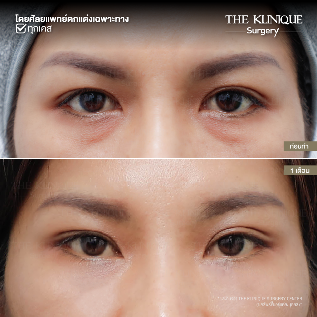 Foxy Eyes, ศัลยกรรมตา, ตาสองชั้น, คลินิกทำตา, ทำตาสองชั้น. ทำตา2ชั้น, กล้ามเนื้อตาอ่อนแรง, แก้ตา, แก้หนังตาตก,หางตาตก, ตาตก,ยกหางตา, แก้ตา, แก้ตาสองชั้น, แก้หนังตาตก , แก้ตาไม่เท่ากัน ,หนังตาตก,แก้หนังตาตก
