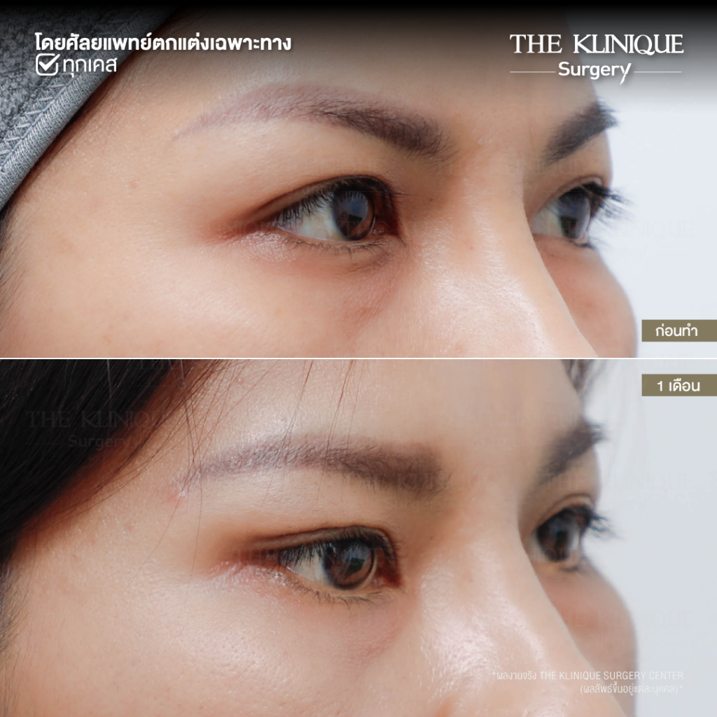 Foxy Eyes, ศัลยกรรมตา, ตาสองชั้น, คลินิกทำตา, ทำตาสองชั้น. ทำตา2ชั้น, กล้ามเนื้อตาอ่อนแรง, แก้ตา, แก้หนังตาตก,หางตาตก, ตาตก,ยกหางตา, แก้ตา, แก้ตาสองชั้น, แก้หนังตาตก , แก้ตาไม่เท่ากัน ,หนังตาตก,แก้หนังตาตก