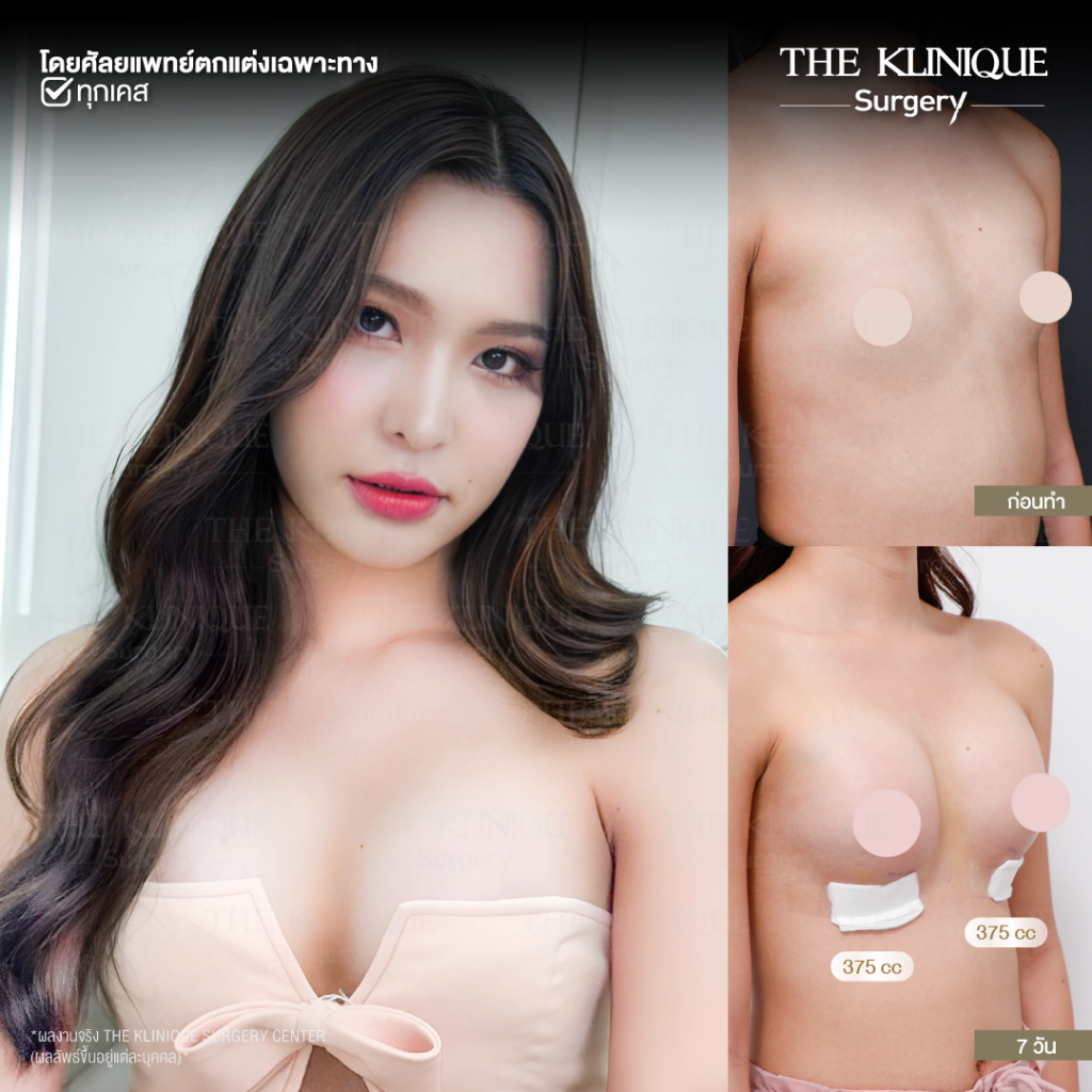 ทำหน้าอก, เสริมหน้าอก, ศัลยกรรมหน้าอก, เสริมหน้าอกที่ไหนดี, แก้หน้าอก, แก้หน้าอกที่ไหนดี, เสริมหน้าอกราคา, แก้หน้าอก ราคา, รีวิวแก้หน้าอก, รีวิวเสริมหน้าอก, แก้หน้าอกไม่เท่ากัน, ทำหน้าอก, ทำนม, ซิลิโคนหน้าอก
