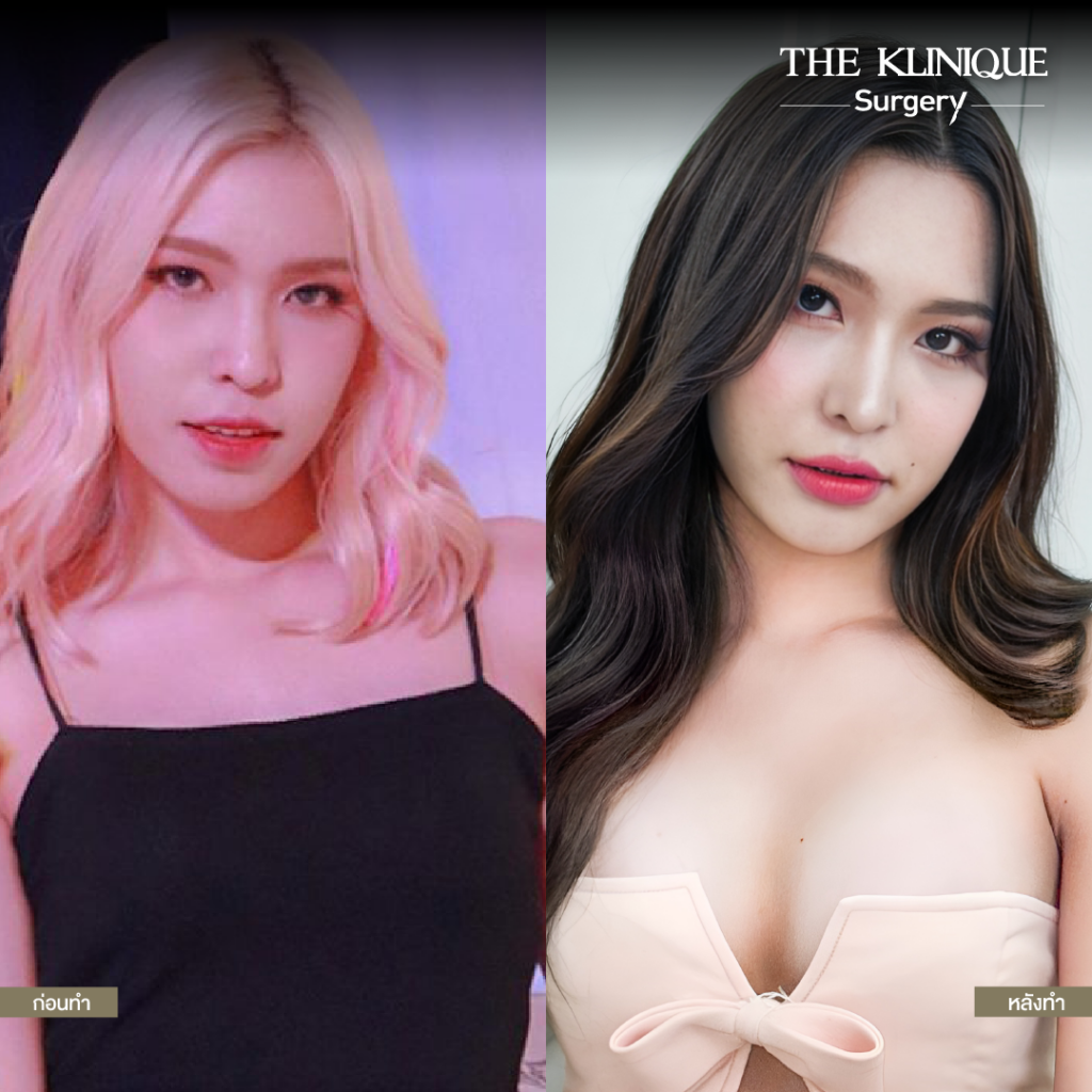 ทำหน้าอก, เสริมหน้าอก, ศัลยกรรมหน้าอก, เสริมหน้าอกที่ไหนดี, แก้หน้าอก, แก้หน้าอกที่ไหนดี, เสริมหน้าอกราคา, แก้หน้าอก ราคา, รีวิวแก้หน้าอก, รีวิวเสริมหน้าอก, แก้หน้าอกไม่เท่ากัน, ทำหน้าอก, ทำนม, ซิลิโคนหน้าอก

