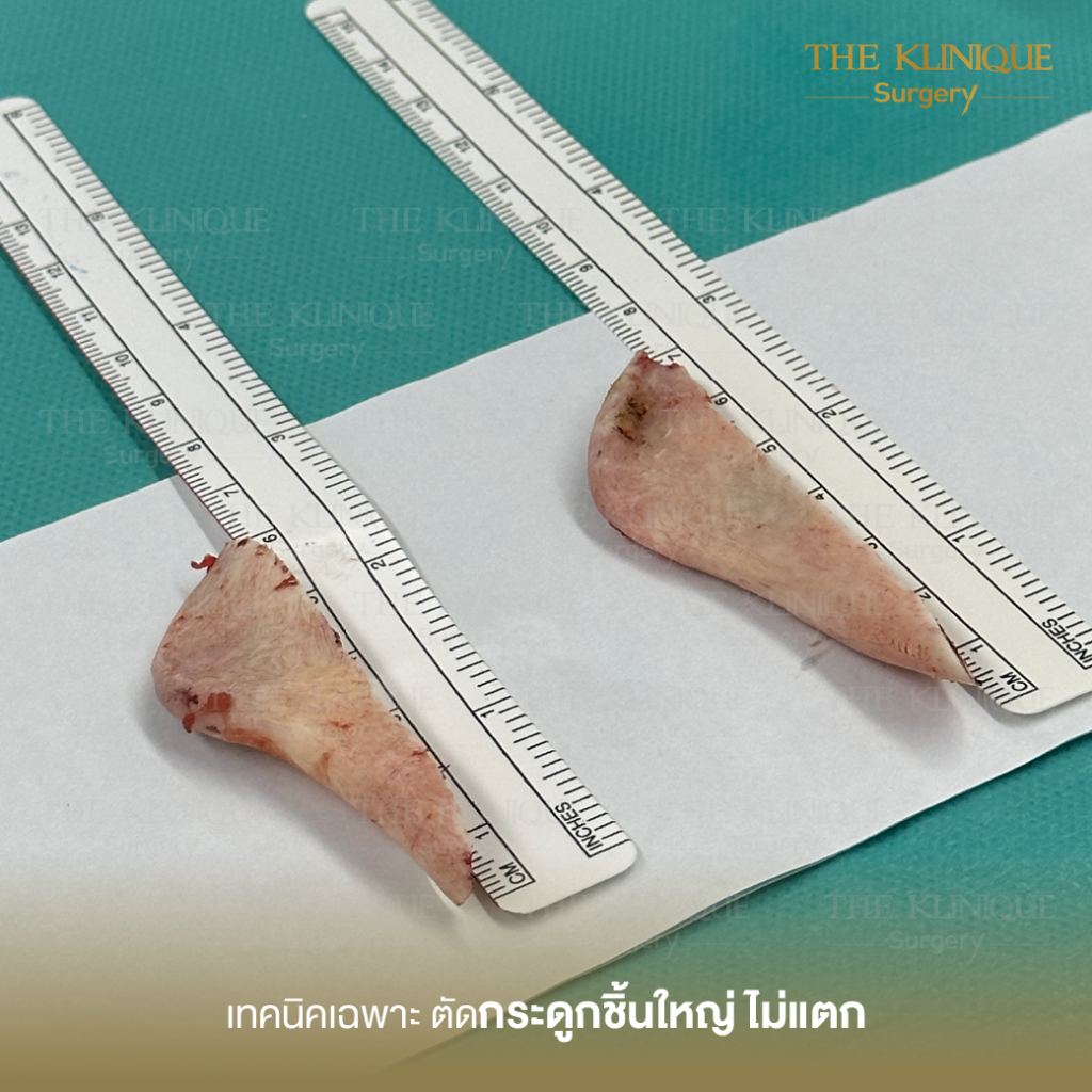 ตัดกราม, ศัลยกรรมตัดกราม, เหลากราม, ตัดกราม วีไลน์, ตัดกราม V-Line, ตัดกรามที่ไหนดี, ตัดกราม ราคา รีวิวตัดกราม, เหลากราม, รีวิว เหลากราม, ลดกราม, ยุบโหนก ตัดกราม
