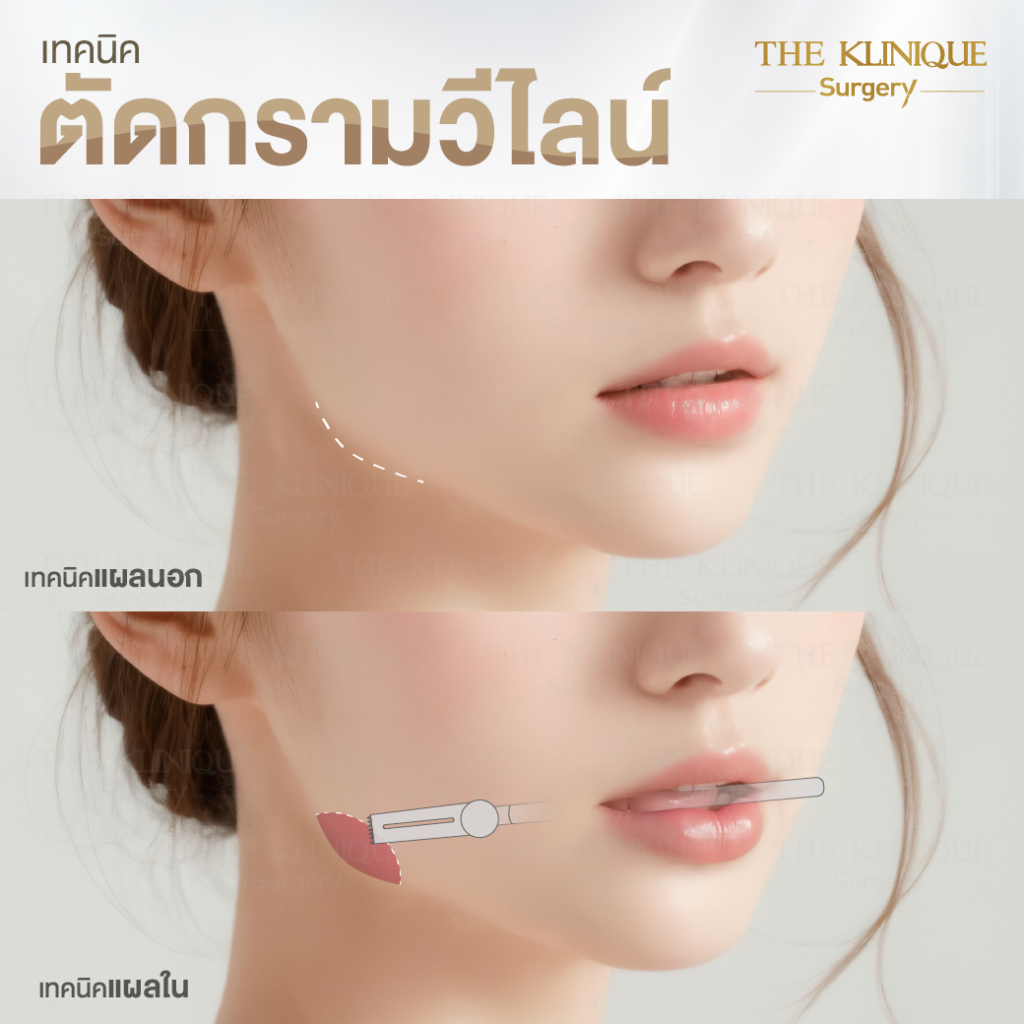 ตัดกราม, ศัลยกรรมตัดกราม, เหลากราม, ตัดกราม วีไลน์, ตัดกราม V-Line, ตัดกรามที่ไหนดี, ตัดกราม ราคา รีวิวตัดกราม, เหลากราม, รีวิว เหลากราม, ลดกราม, ยุบโหนก ตัดกราม