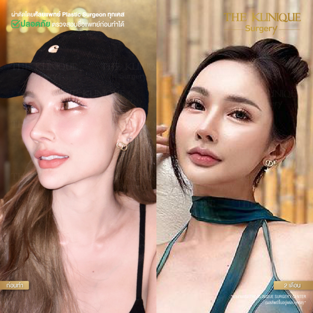 ตัดกราม, ศัลยกรรมตัดกราม, เหลากราม, ตัดกราม วีไลน์, ตัดกราม V-Line, ตัดกรามที่ไหนดี, ตัดกราม ราคา รีวิวตัดกราม, เหลากราม, รีวิว เหลากราม, ลดกราม, ยุบโหนก ตัดกราม