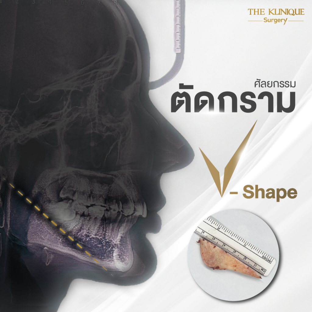 ตัดกราม, ศัลยกรรมตัดกราม, เหลากราม, ตัดกราม วีไลน์, ตัดกราม V-Line, ตัดกรามที่ไหนดี, ตัดกราม ราคา รีวิวตัดกราม, เหลากราม, รีวิว เหลากราม, ลดกราม, ยุบโหนก ตัดกราม