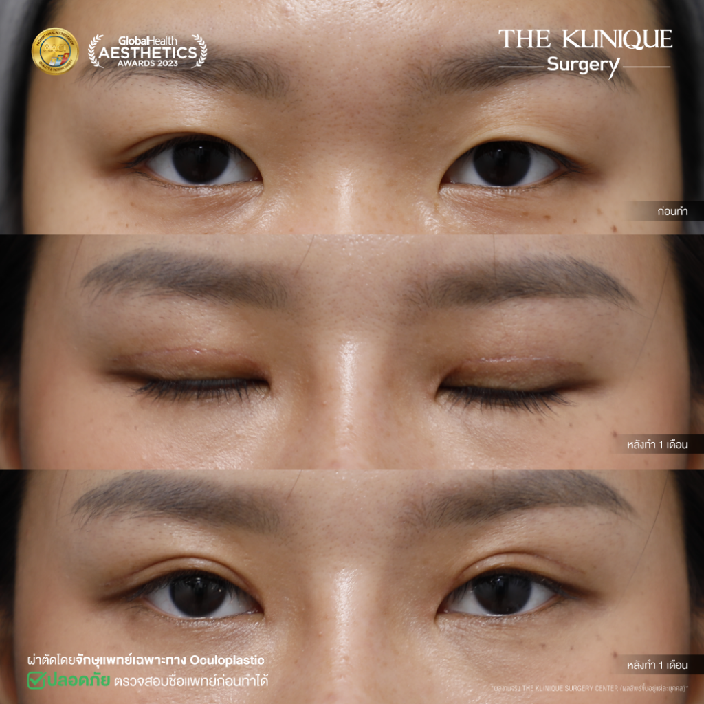 Foxy Eyes, ศัลยกรรมตา, ตาสองชั้น, คลินิกทำตา, ทำตาสองชั้น. ทำตา2ชั้น, กล้ามเนื้อตาอ่อนแรง, แก้ตา, แก้หนังตาตก,หางตาตก, ตาตก,ยกหางตา, แก้ตา, แก้ตาสองชั้น, แก้หนังตาตก , แก้ตาไม่เท่ากัน ,หนังตาตก,แก้หนังตาตก