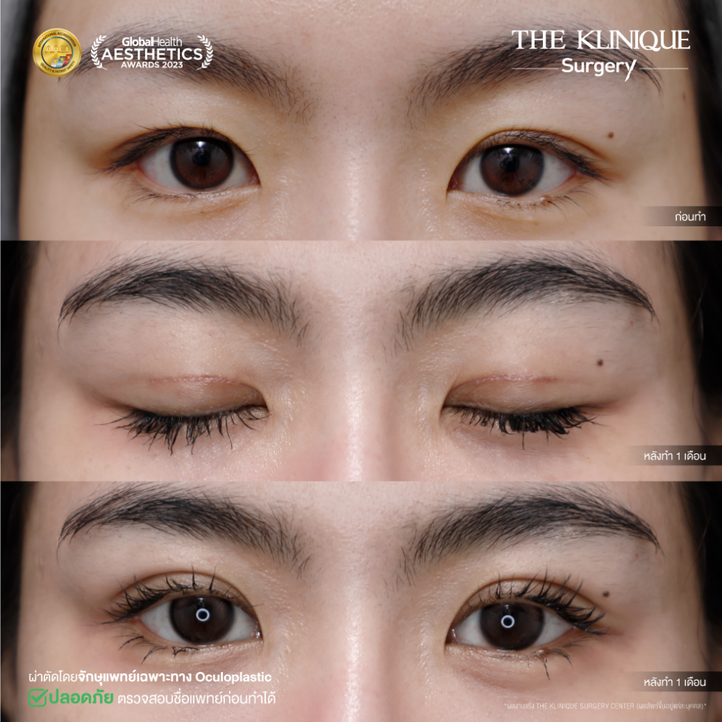 Foxy Eyes, ศัลยกรรมตา, ตาสองชั้น, คลินิกทำตา, ทำตาสองชั้น. ทำตา2ชั้น, กล้ามเนื้อตาอ่อนแรง, แก้ตา, แก้หนังตาตก,หางตาตก, ตาตก,ยกหางตา, แก้ตา, แก้ตาสองชั้น, แก้หนังตาตก , แก้ตาไม่เท่ากัน ,หนังตาตก,แก้หนังตาตก