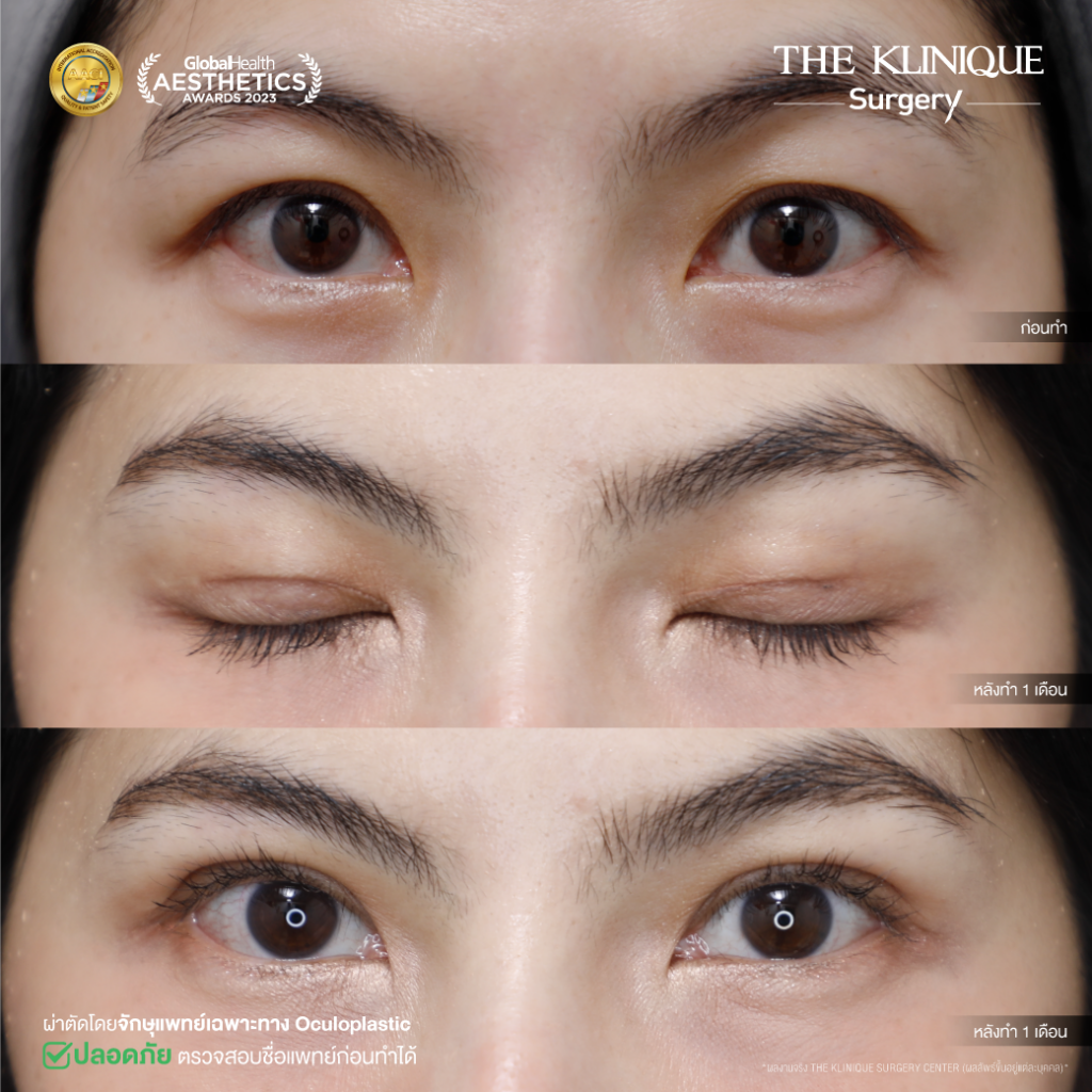 Foxy Eyes, ศัลยกรรมตา, ตาสองชั้น, คลินิกทำตา, ทำตาสองชั้น. ทำตา2ชั้น, กล้ามเนื้อตาอ่อนแรง, แก้ตา, แก้หนังตาตก,หางตาตก, ตาตก,ยกหางตา, แก้ตา, แก้ตาสองชั้น, แก้หนังตาตก , แก้ตาไม่เท่ากัน ,หนังตาตก,แก้หนังตาตก