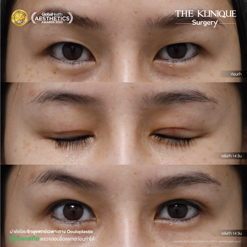 Foxy Eyes, ศัลยกรรมตา, ตาสองชั้น, คลินิกทำตา, ทำตาสองชั้น. ทำตา2ชั้น, กล้ามเนื้อตาอ่อนแรง, แก้ตา, แก้หนังตาตก,หางตาตก, ตาตก,ยกหางตา, แก้ตา, แก้ตาสองชั้น, แก้หนังตาตก , แก้ตาไม่เท่ากัน ,หนังตาตก,แก้หนังตาตก