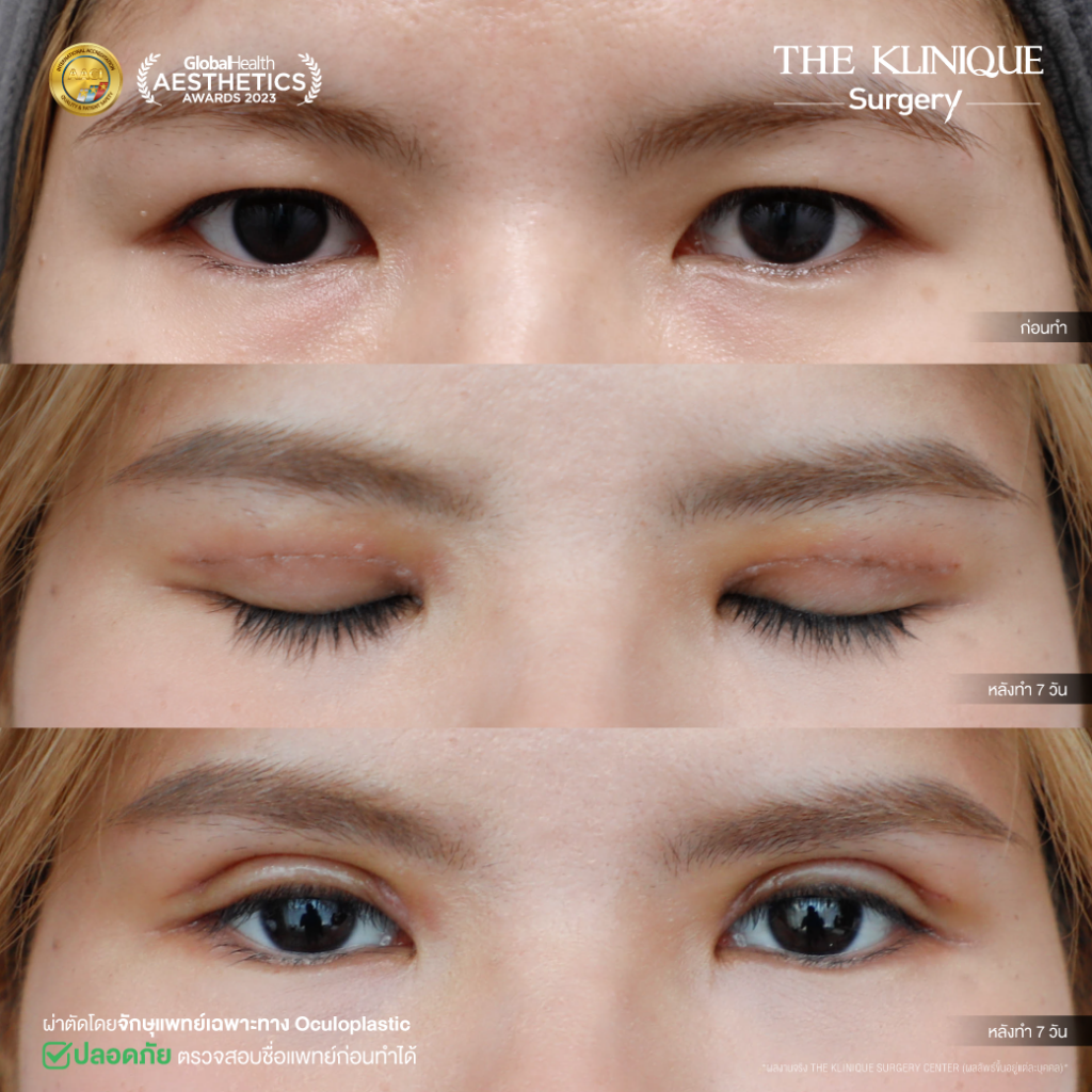 Foxy Eyes, ศัลยกรรมตา, ตาสองชั้น, คลินิกทำตา, ทำตาสองชั้น. ทำตา2ชั้น, กล้ามเนื้อตาอ่อนแรง, แก้ตา, แก้หนังตาตก,หางตาตก, ตาตก,ยกหางตา, แก้ตา, แก้ตาสองชั้น, แก้หนังตาตก , แก้ตาไม่เท่ากัน ,หนังตาตก,แก้หนังตาตก