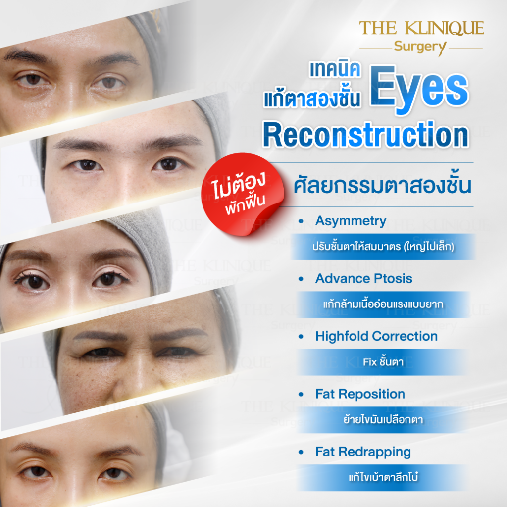 Foxy Eyes, ศัลยกรรมตา, ตาสองชั้น, คลินิกทำตา, ทำตาสองชั้น. ทำตา2ชั้น, กล้ามเนื้อตาอ่อนแรง, แก้ตา, แก้หนังตาตก,หางตาตก, ตาตก,ยกหางตา, แก้ตา, แก้ตาสองชั้น, แก้หนังตาตก , แก้ตาไม่เท่ากัน ,หนังตาตก,แก้หนังตาตก